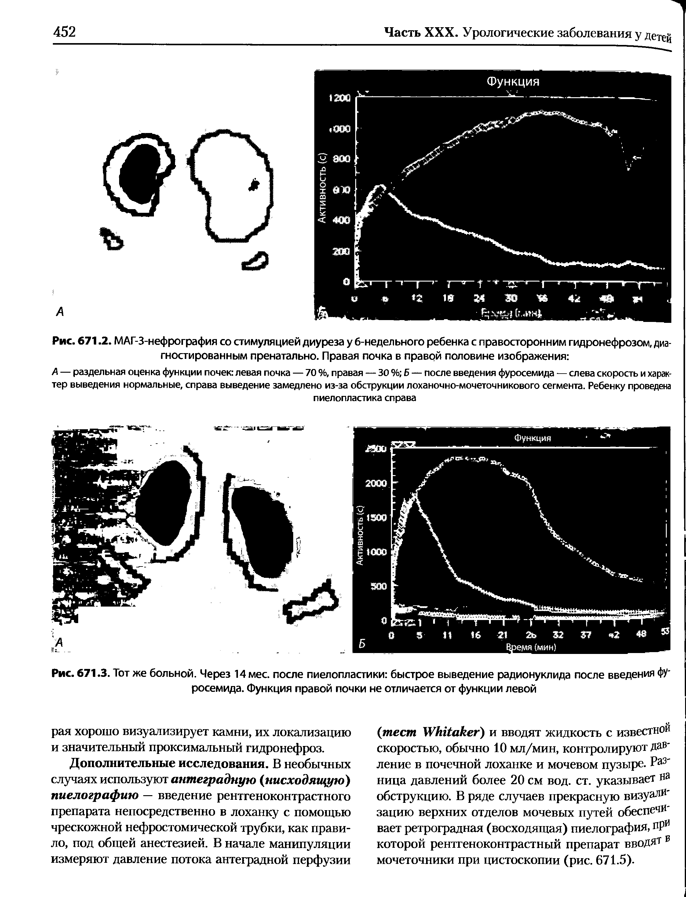 Рис. 671.2. МАГ-З-нефрография со стимуляцией диуреза у 6-недельного ребенка с правосторонним гидронефрозом, диагностированным пренатально. Правая почка в правой половине изображения ...