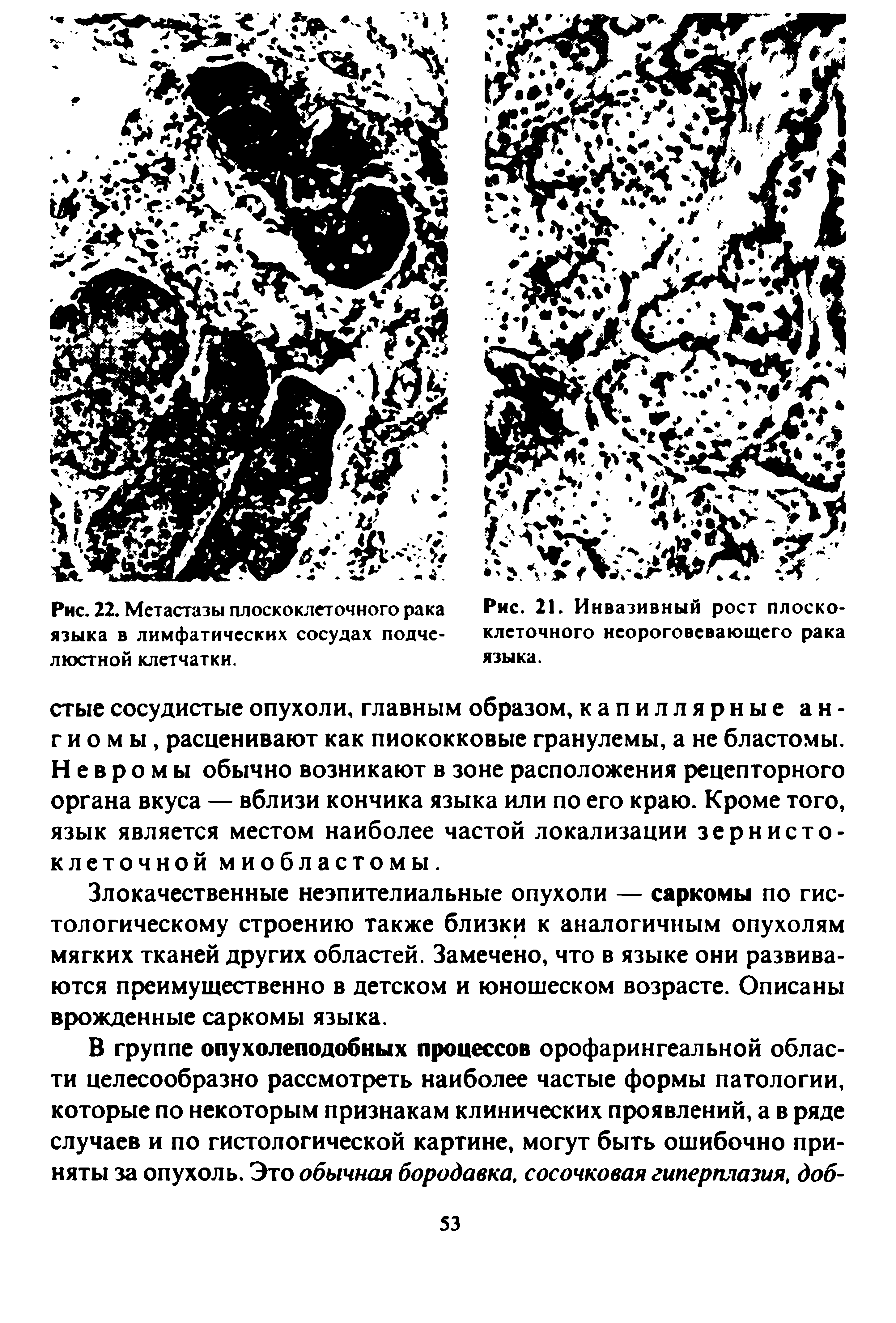 Рис. 21. Инвазивный рост плоскоклеточного неороговевающего рака языка.