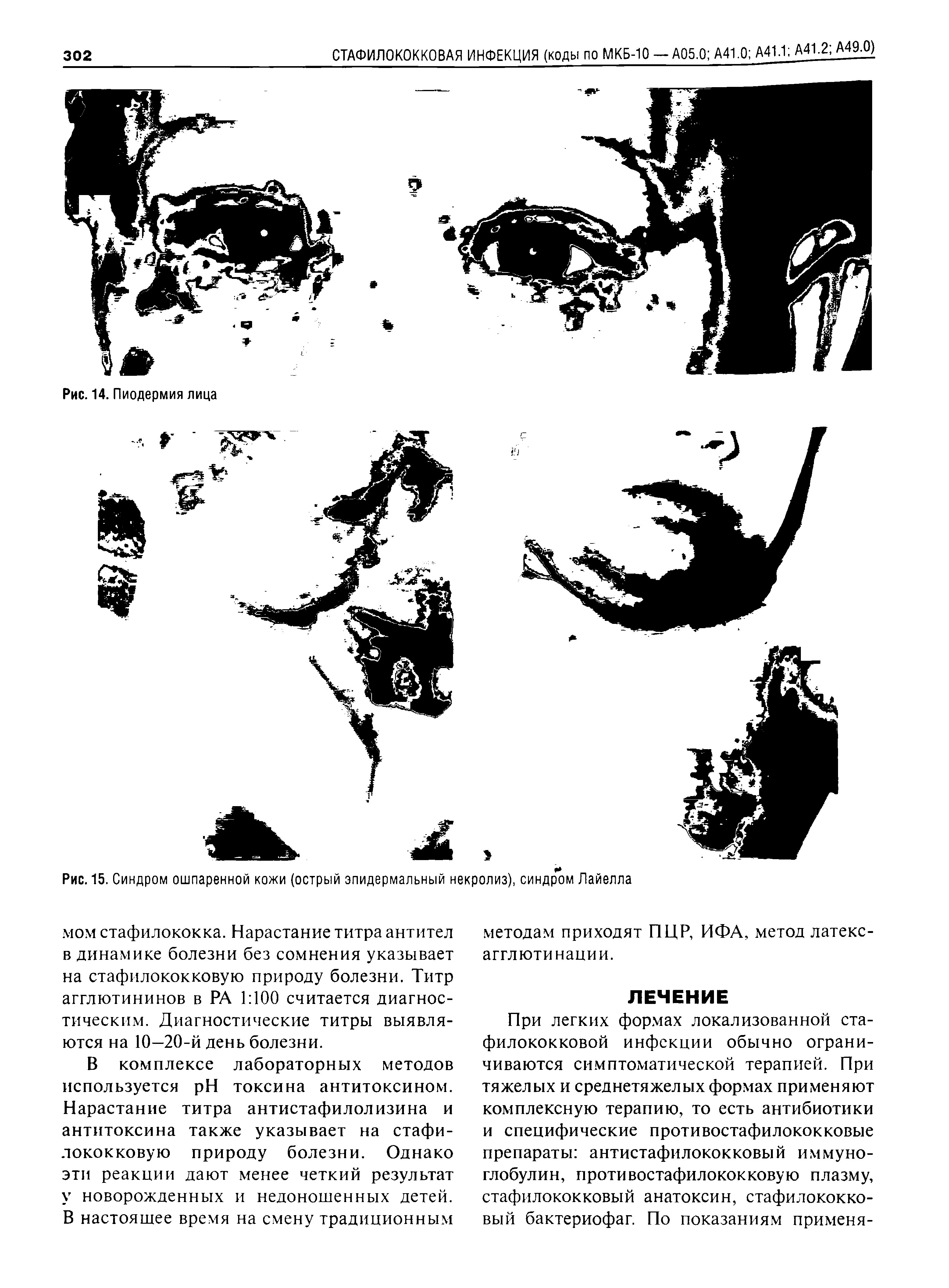 Рис. 15. Синдром ошпаренной кожи (острый эпидермальный некролиз), синдром Лайелла...