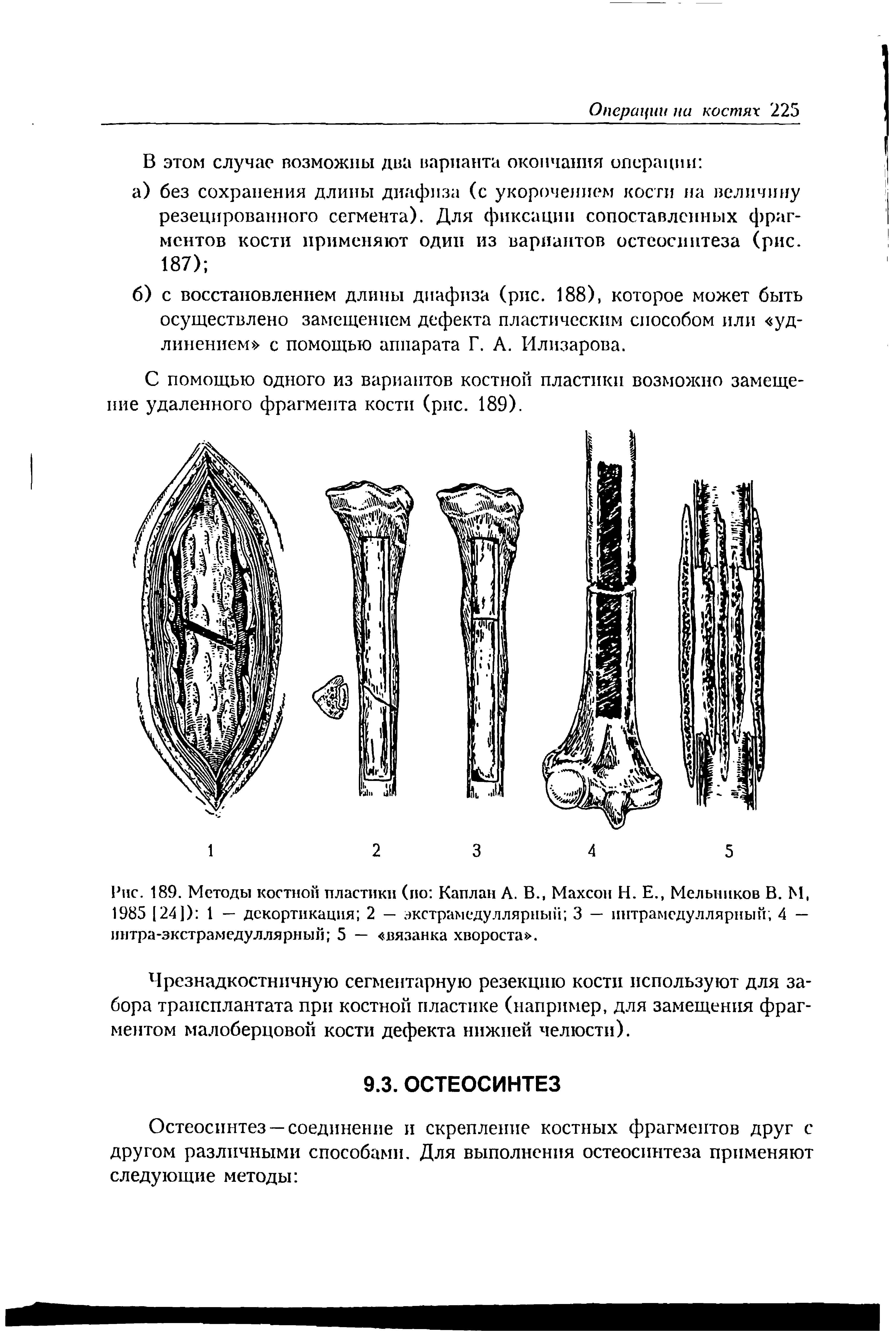 Рис. 189. Методы костной пластики (по Каплан А. В., Махсон Н. Е., Мельников В. М, 1985 124]) 1 — декортикация 2 — экстрамедуллярный 3 — интрамедуллярный, 4 — интра-зкетрамедуллярный 5 — вязанка хвороста .