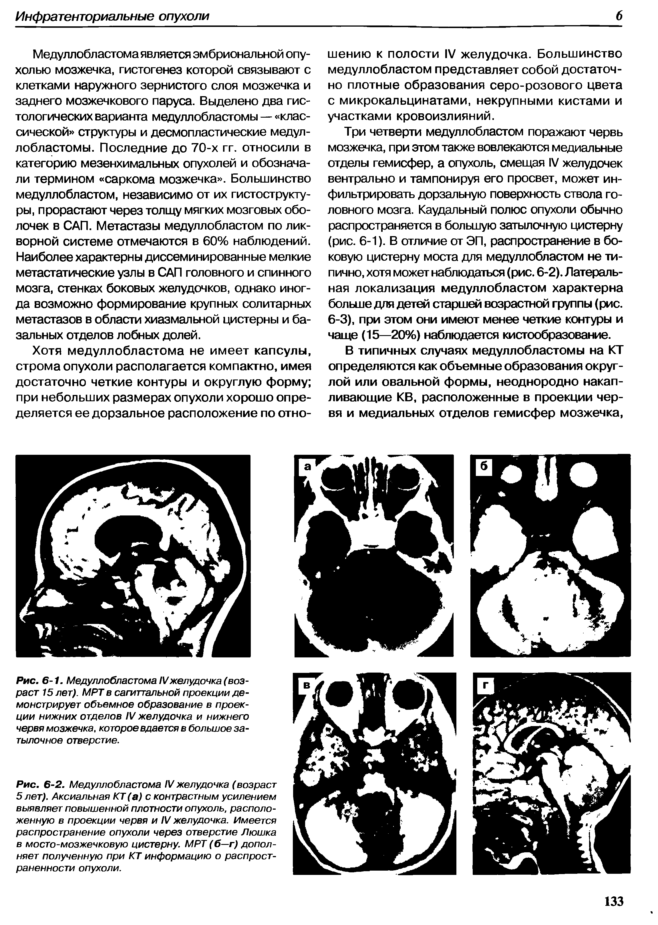 Рис. 6-2. Медуллобластома IV желудочка (возраст 5 лет). Аксиальная КТ (а) с контрастным усилением выявляет повышенной плотности опухоль, расположенную в проекции червя и IV желудочка. Имеется распространение опухоли через отверстие Люшка в мосто-мозжечковую цистерну. МРТ (б—г) дополняет полученную при КТ информацию о распространенности опухоли.