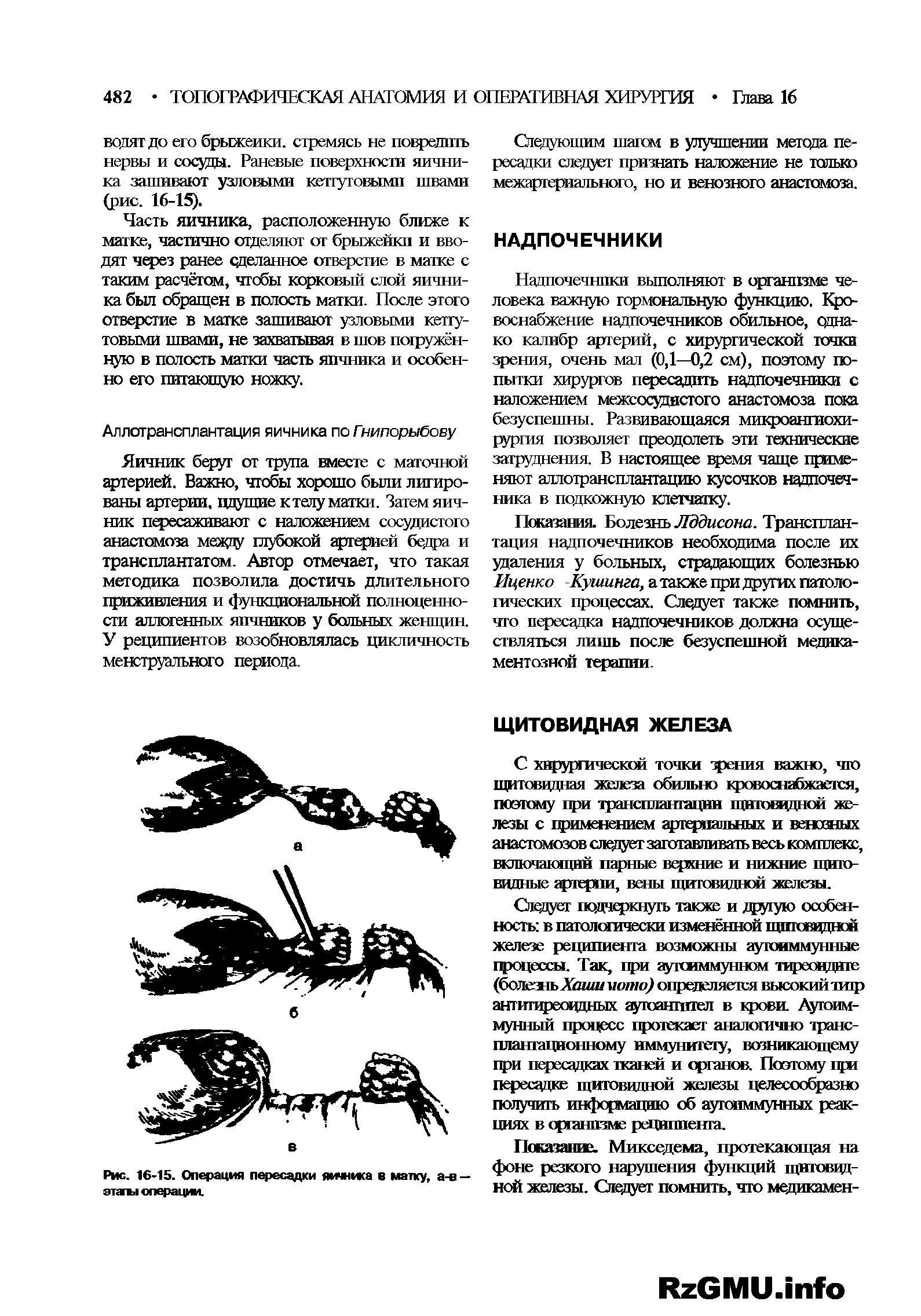 Рис. 16-15. Операция пересадки яичника в матку, а-в — этагы операции.