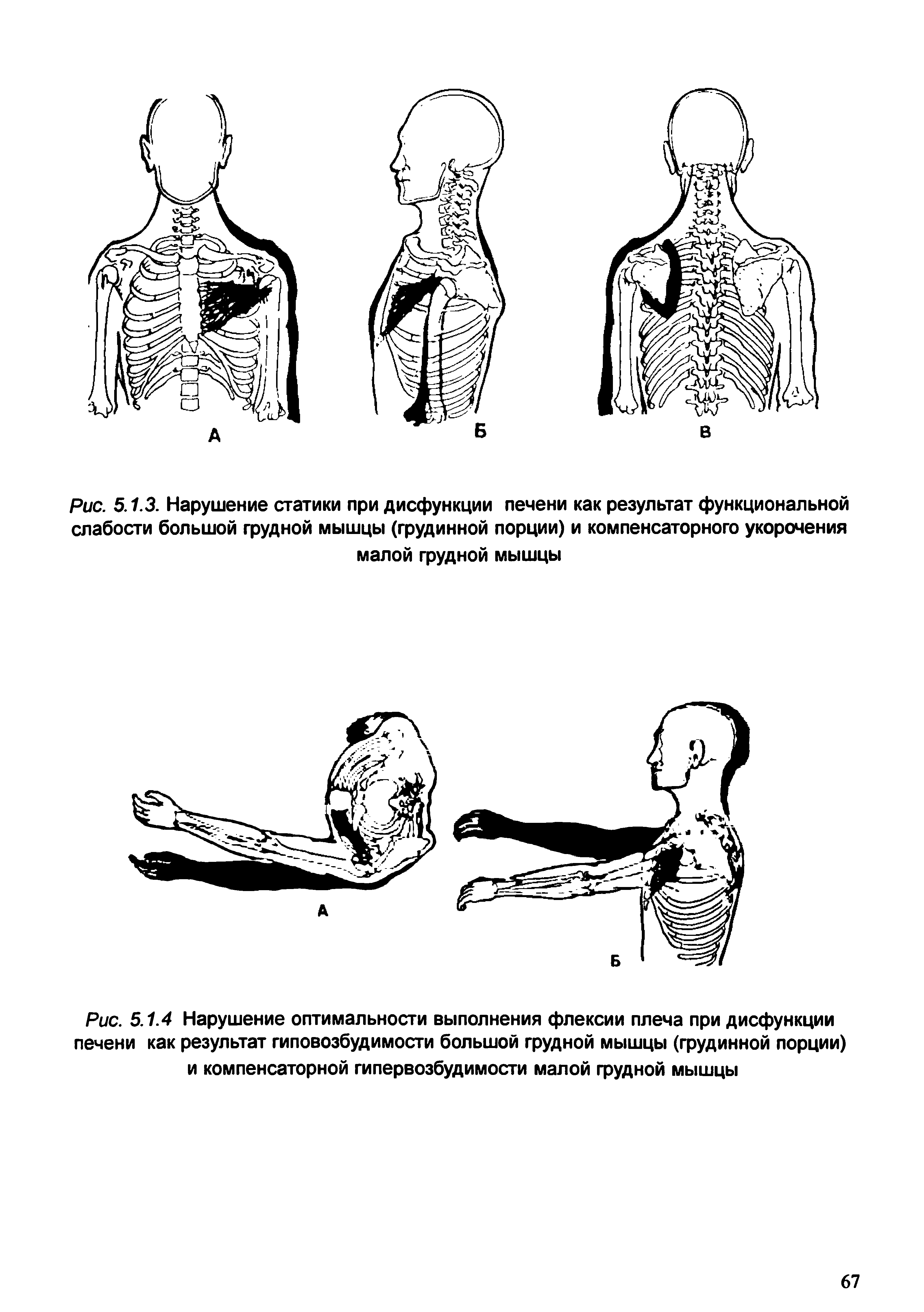 Рис. 5.1.4 Нарушение оптимальности выполнения флексии плеча при дисфункции печени как результат гиповозбудимости большой грудной мышцы (грудинной порции) и компенсаторной гипервозбудимости малой грудной мышцы...