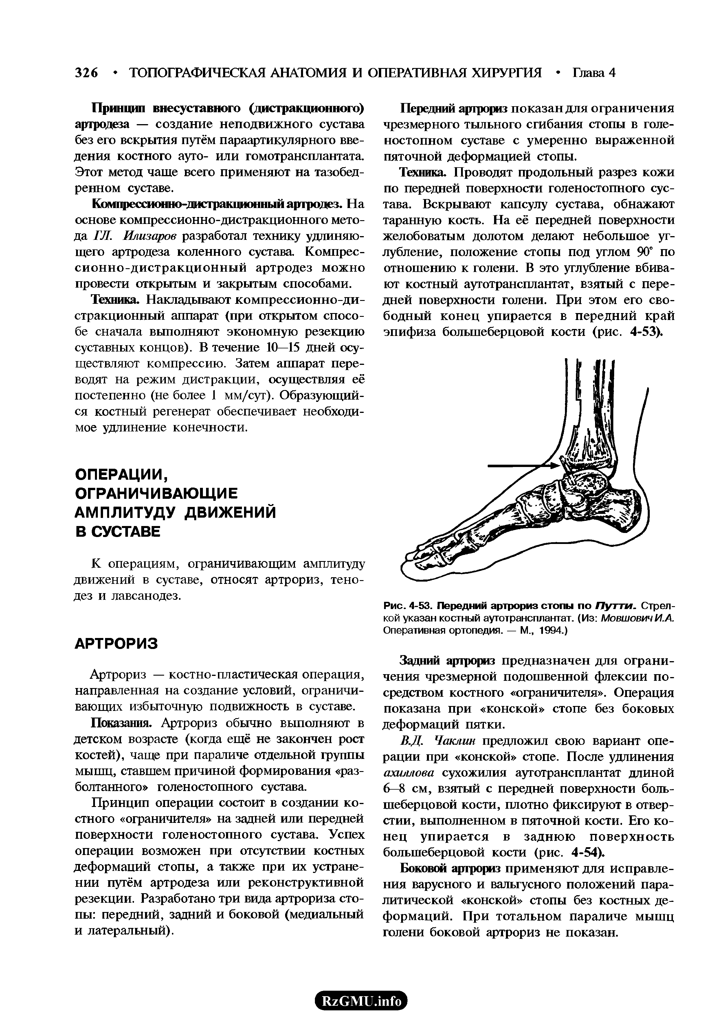 Рис. 4-53. Передний артрориз стопы по Путти. Стрелкой указан костный аутотрансплантат. (Из МовшовичИ.А. Оперативная ортопедия. — М., 1994.)...