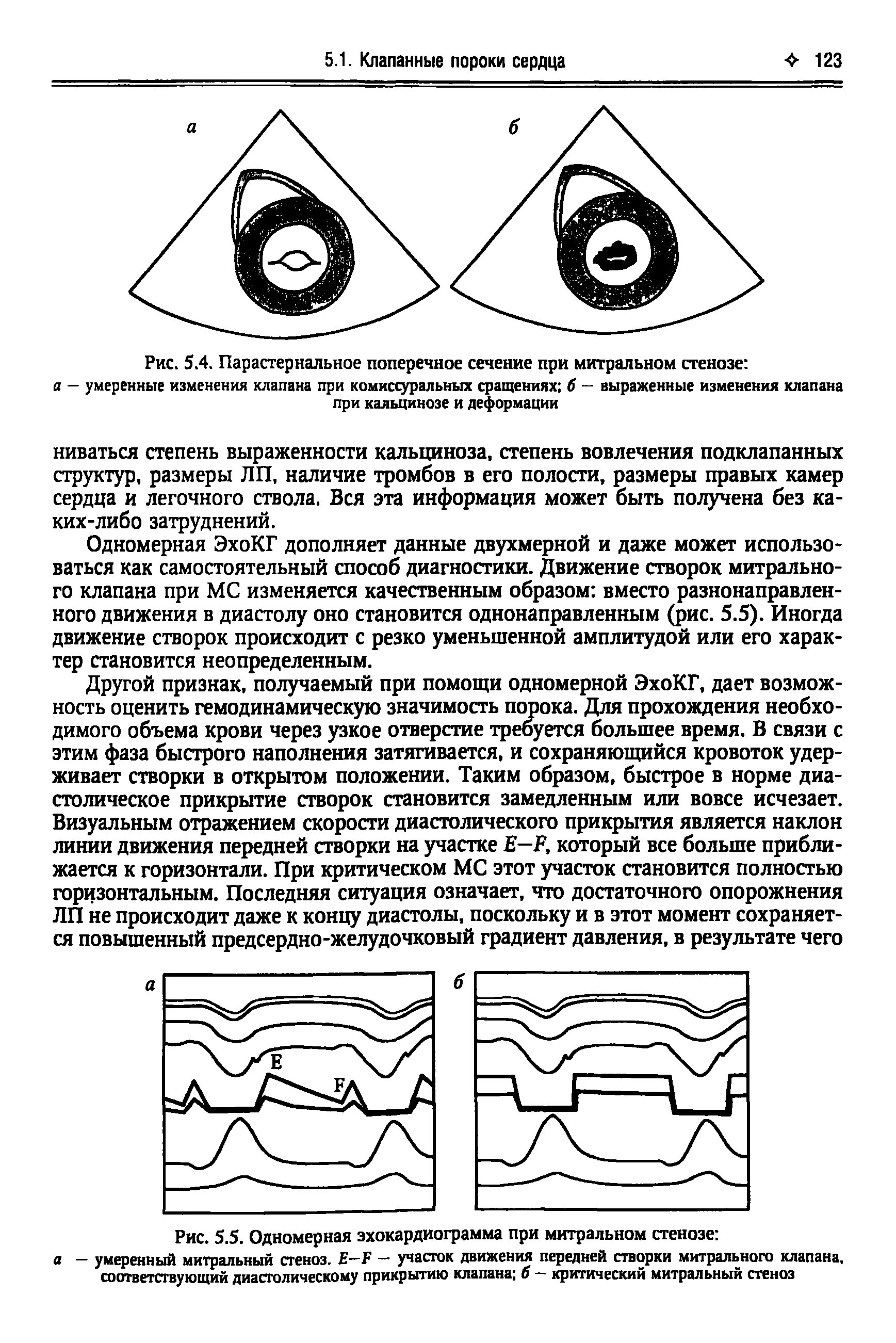 Рис. 5.5. Одномерная эхокардиограмма при митральном стенозе а - умеренный митральный стеноз. Е-Р - участок движения передней створки митрального клапана, соответствующий диастолическому прикрытию клапана б — критический митральный стеноз...