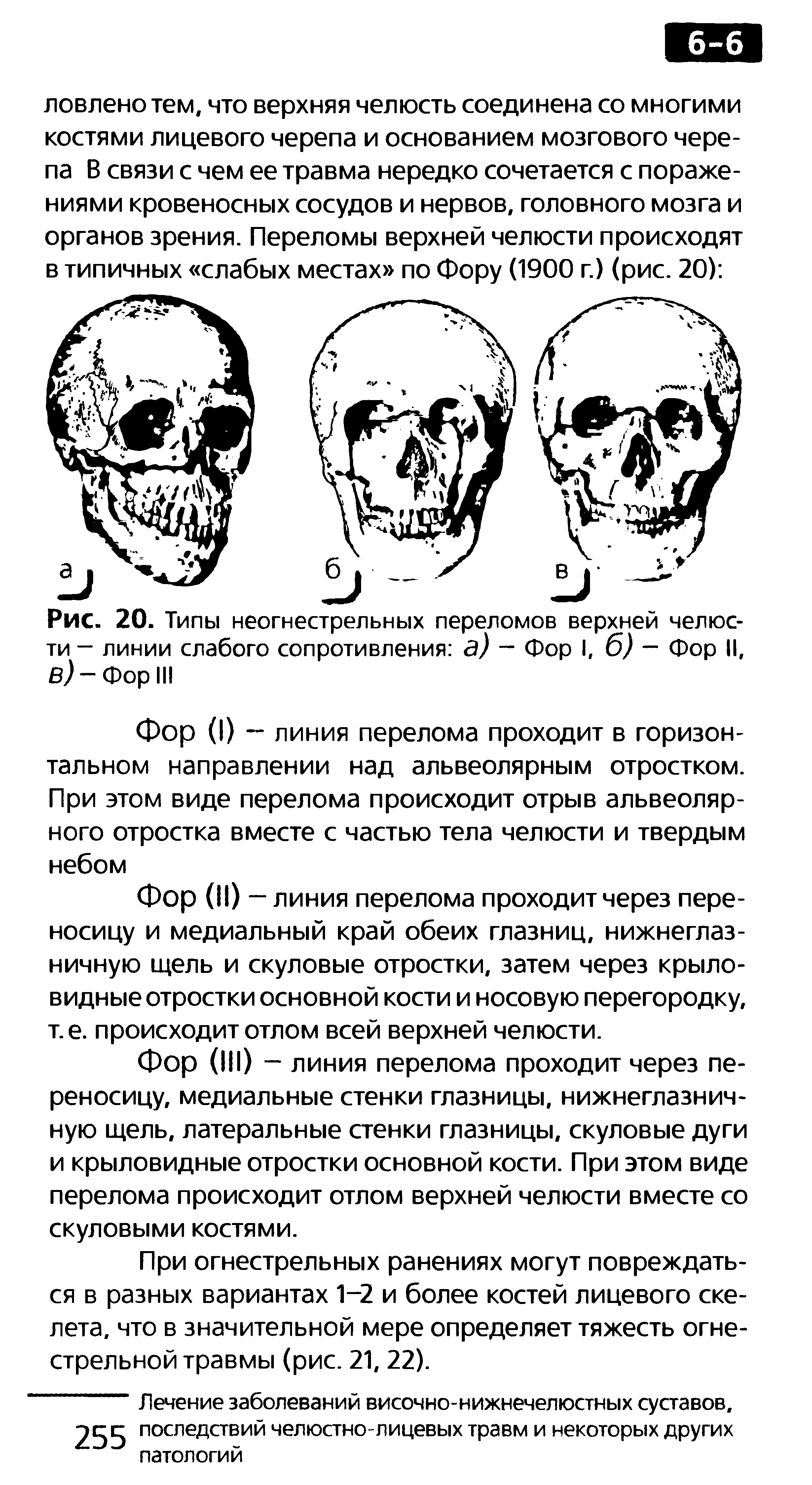 Рис. 20. Типы неогнестрельных переломов верхней челюсти — линии слабого сопротивления з) — Фор I, б) — Фор II, В) - Фор III...