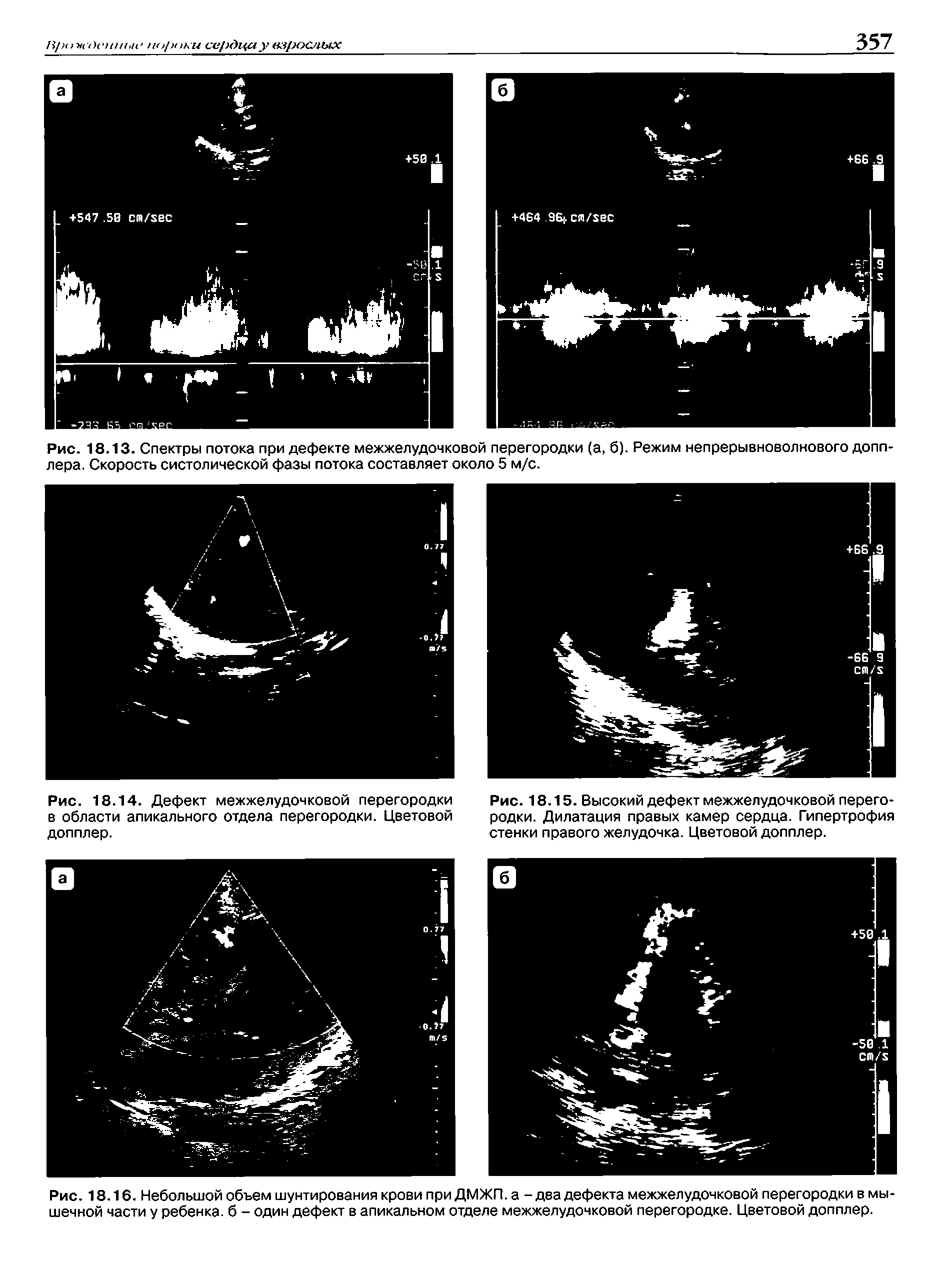 Рис. 18.16. Небольшой объем шунтирования крови при ДМЖП, а -два дефекта межжелудочковой перегородки в мышечной части у ребенка, б - один дефект в апикальном отделе межжелудочковой перегородке. Цветовой допплер.