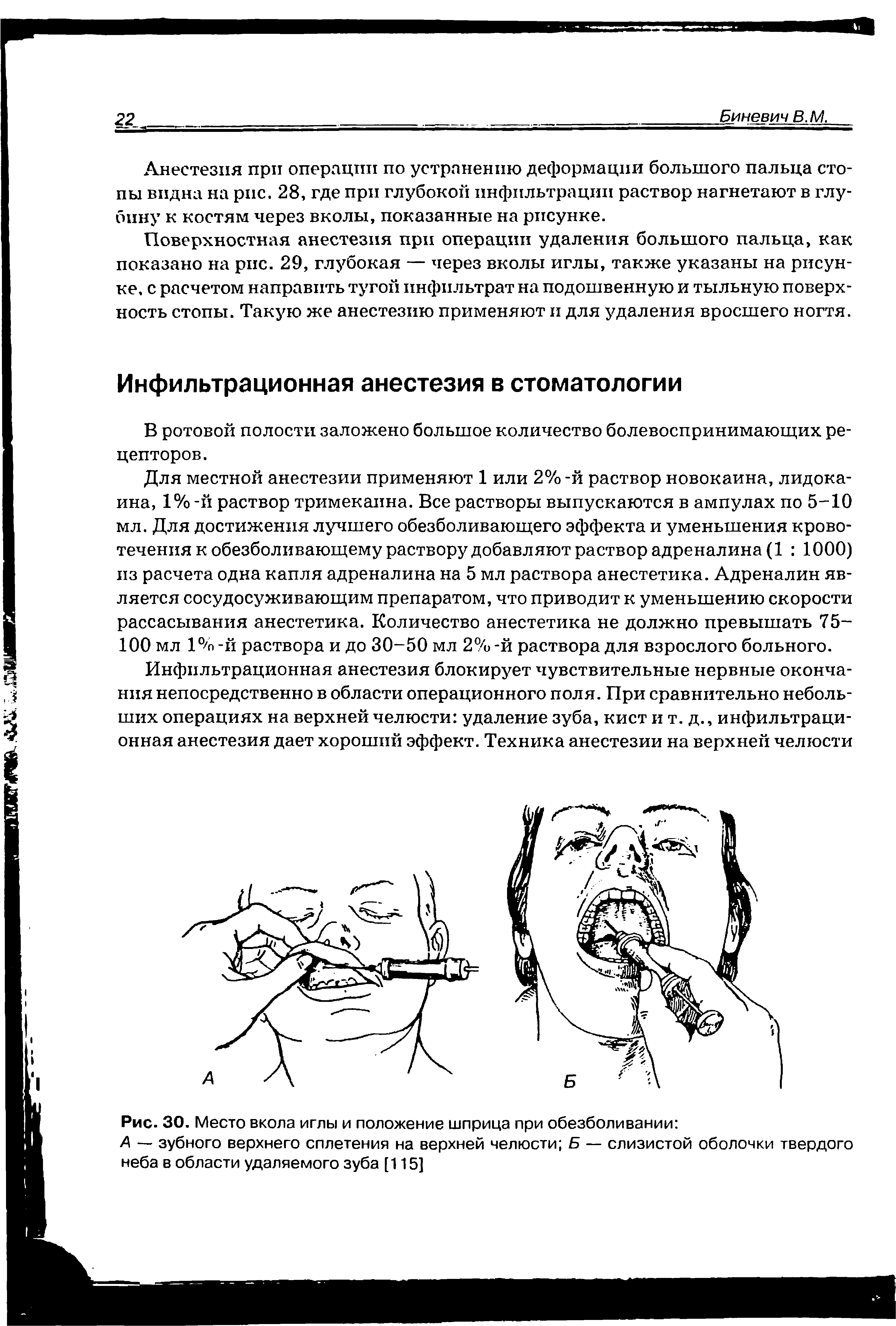 Рис. 30. Место вкола иглы и положение шприца при обезболивании ...