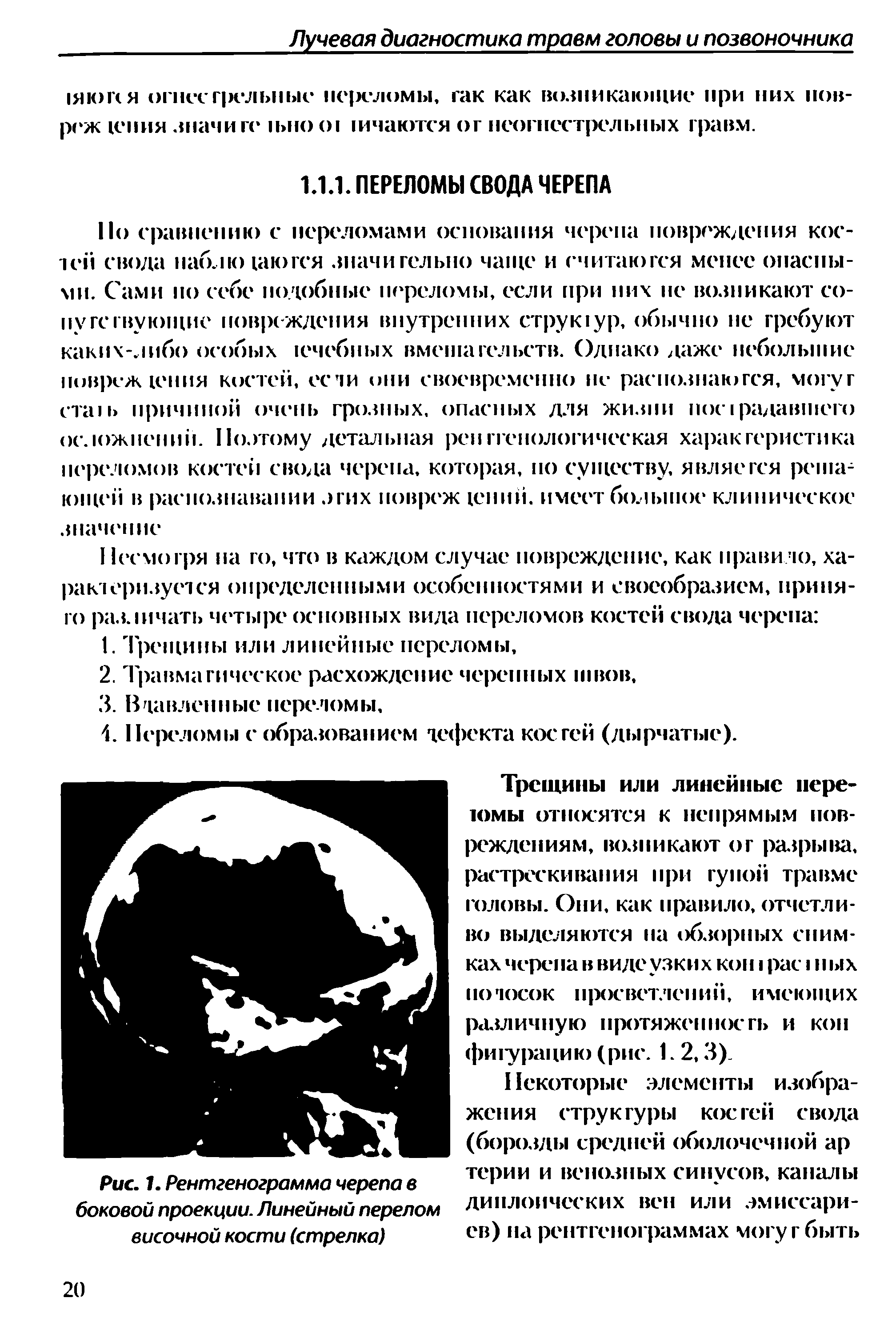 Рис. 1. Рентгенограмма черепа в боковой проекции. Линейный перелом височной кости (стрелка)...