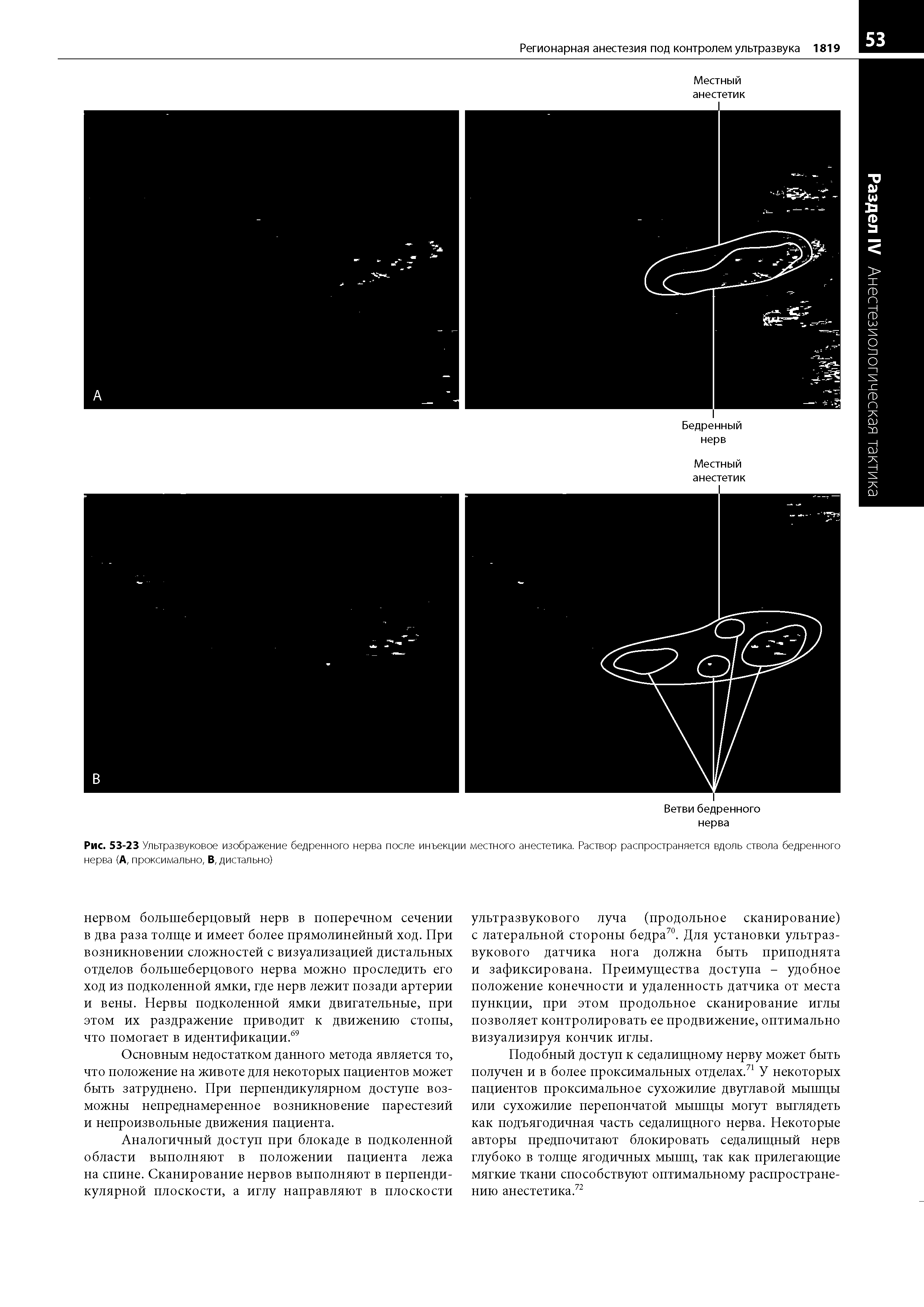 Рис. 53-23 Ультразвуковое изображение бедренного нерва после инъекции местного анестетика. Раствор распространяется вдоль ствола бедренного нерва (А, проксимально, В, дистально)...