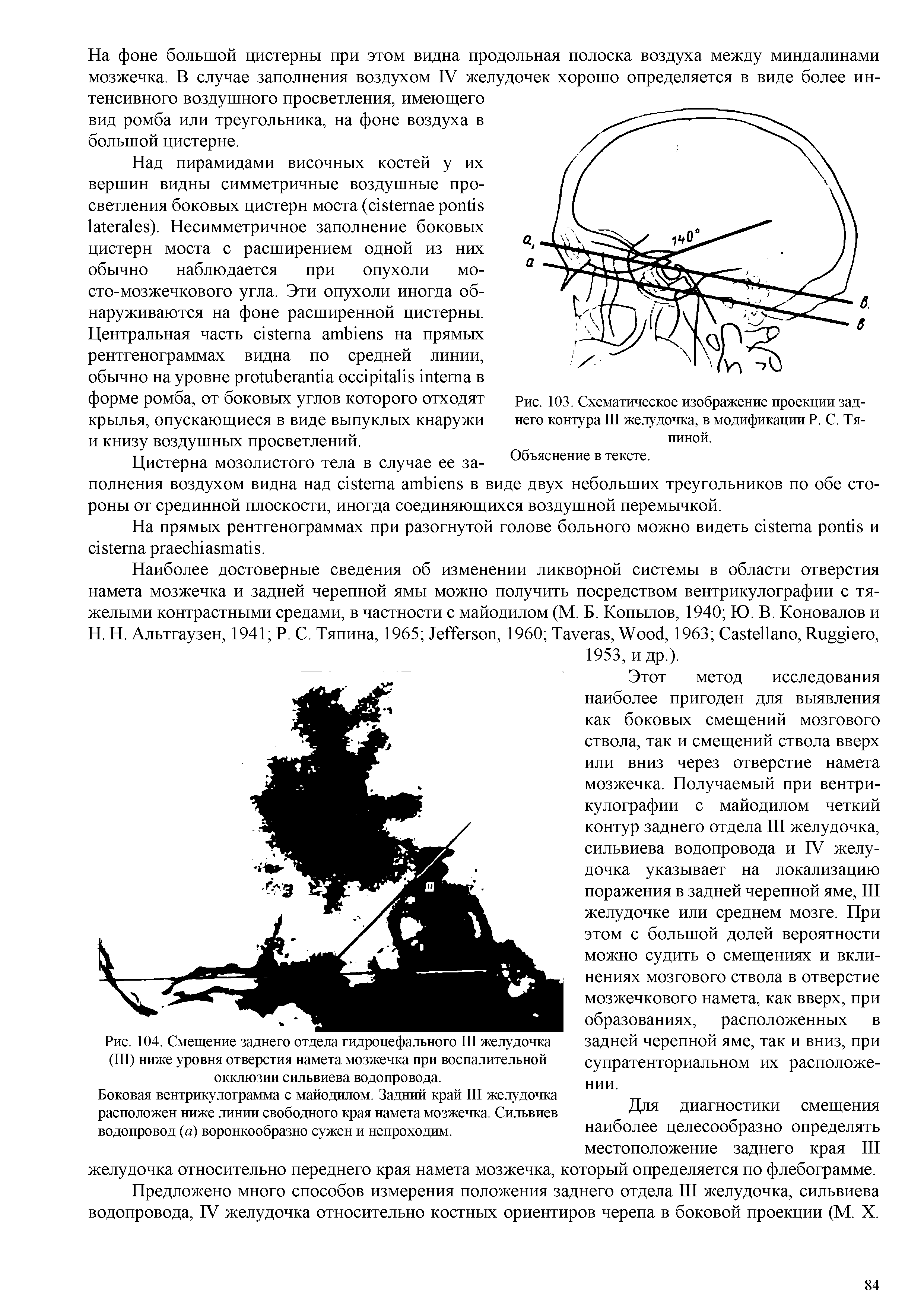 Рис. 104. Смещение заднего отдела гидроцефального III желудочка (III) ниже уровня отверстия намета мозжечка при воспалительной окклюзии сильвиева водопровода.