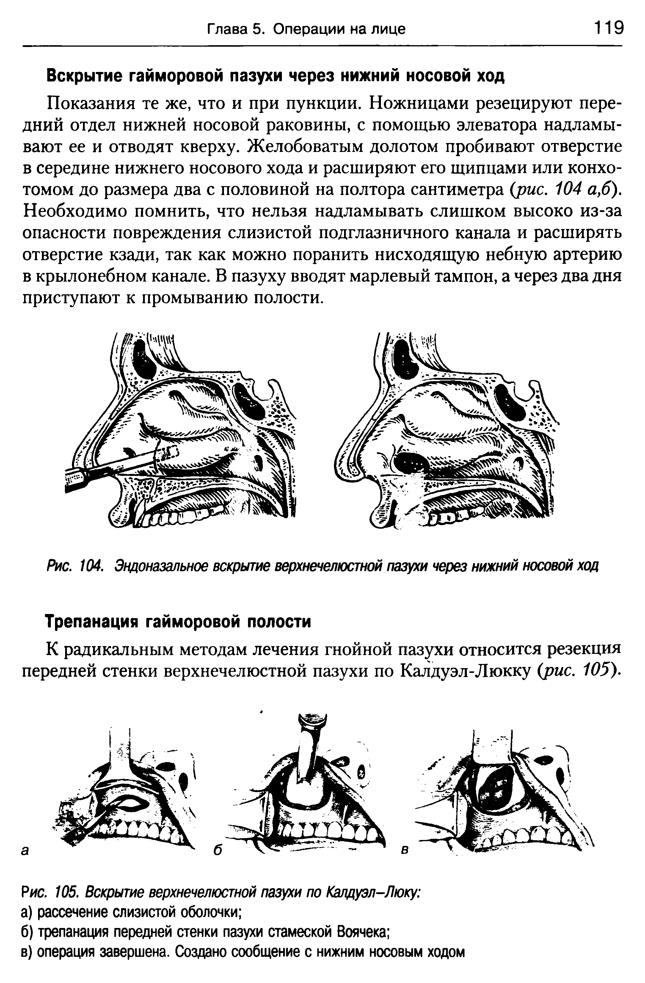 Рис. 104. Эндоназальное вскрытие верхнечелюстной пазухи через нижний носовой ход...