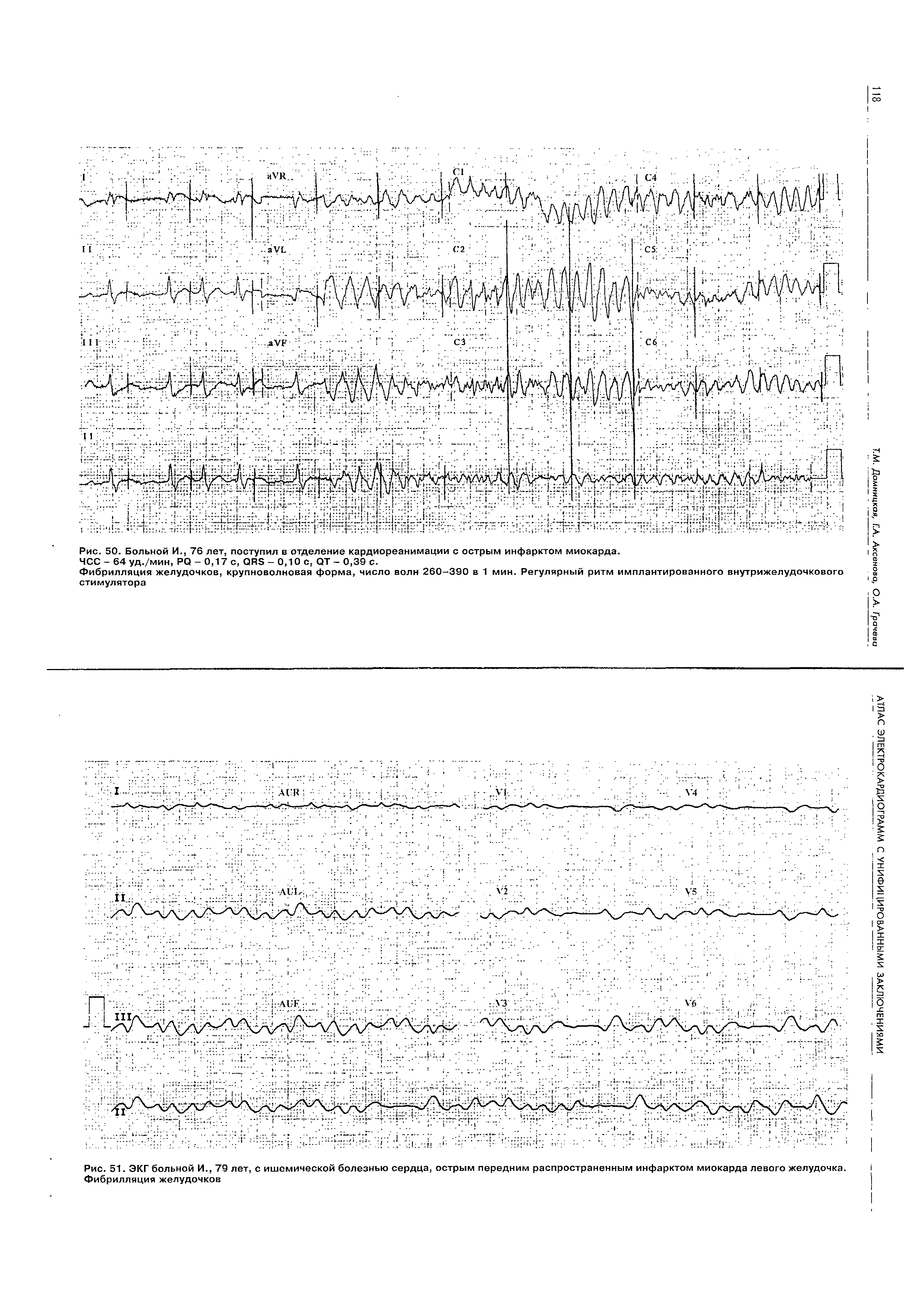 Рис. 51. ЭКГ больной И., 79 лет, с ишемической болезнью сердца, острым передним распространенным инфарктом миокарда левого желудочка. Фибрилляция желудочков...