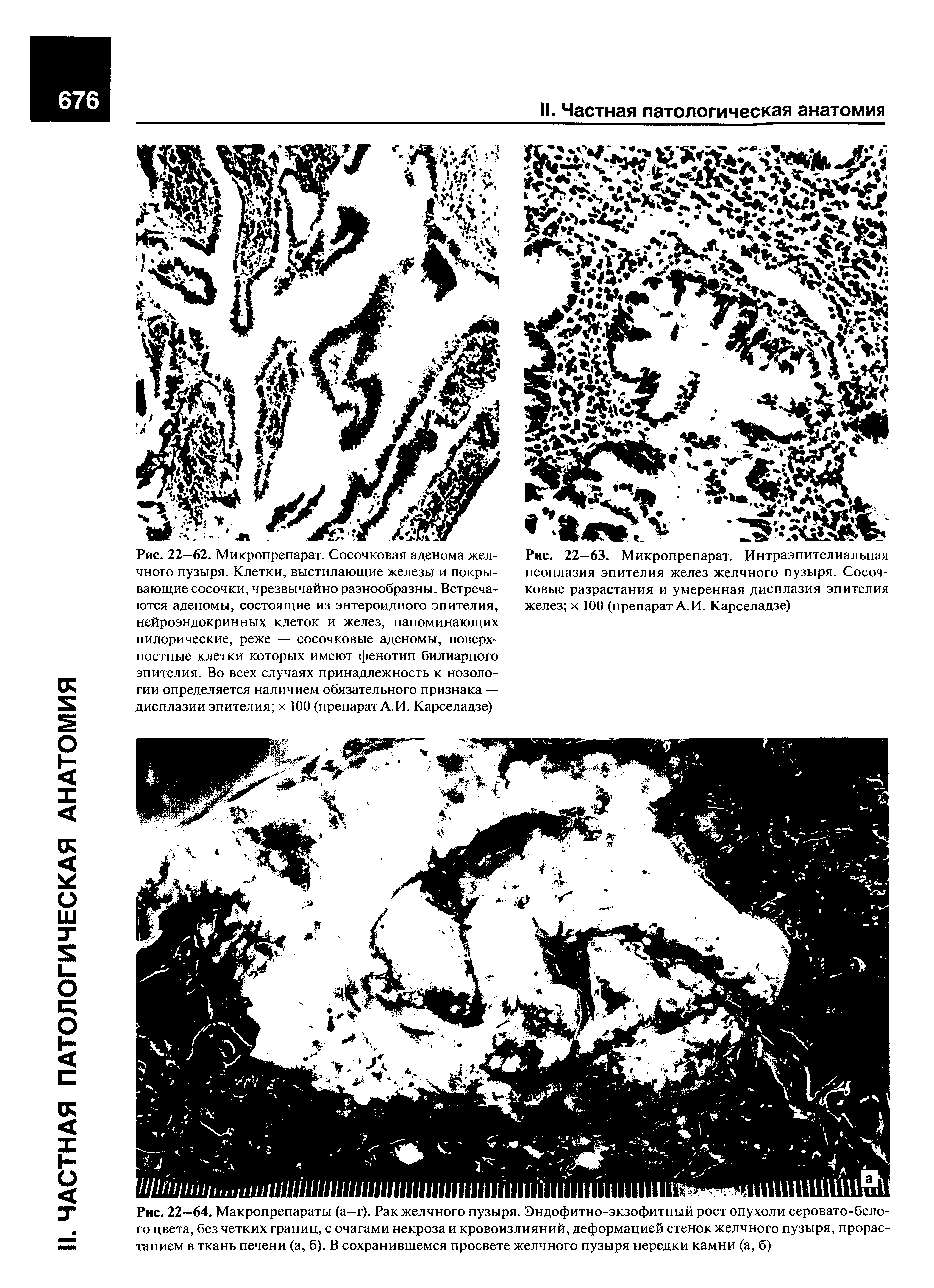 Рис. 22—63. Микропрепарат. Интраэпителиальная неоплазия эпителия желез желчного пузыря. Сосочковые разрастания и умеренная дисплазия эпителия желез х 100 (препарат А.И. Карселадзе)...