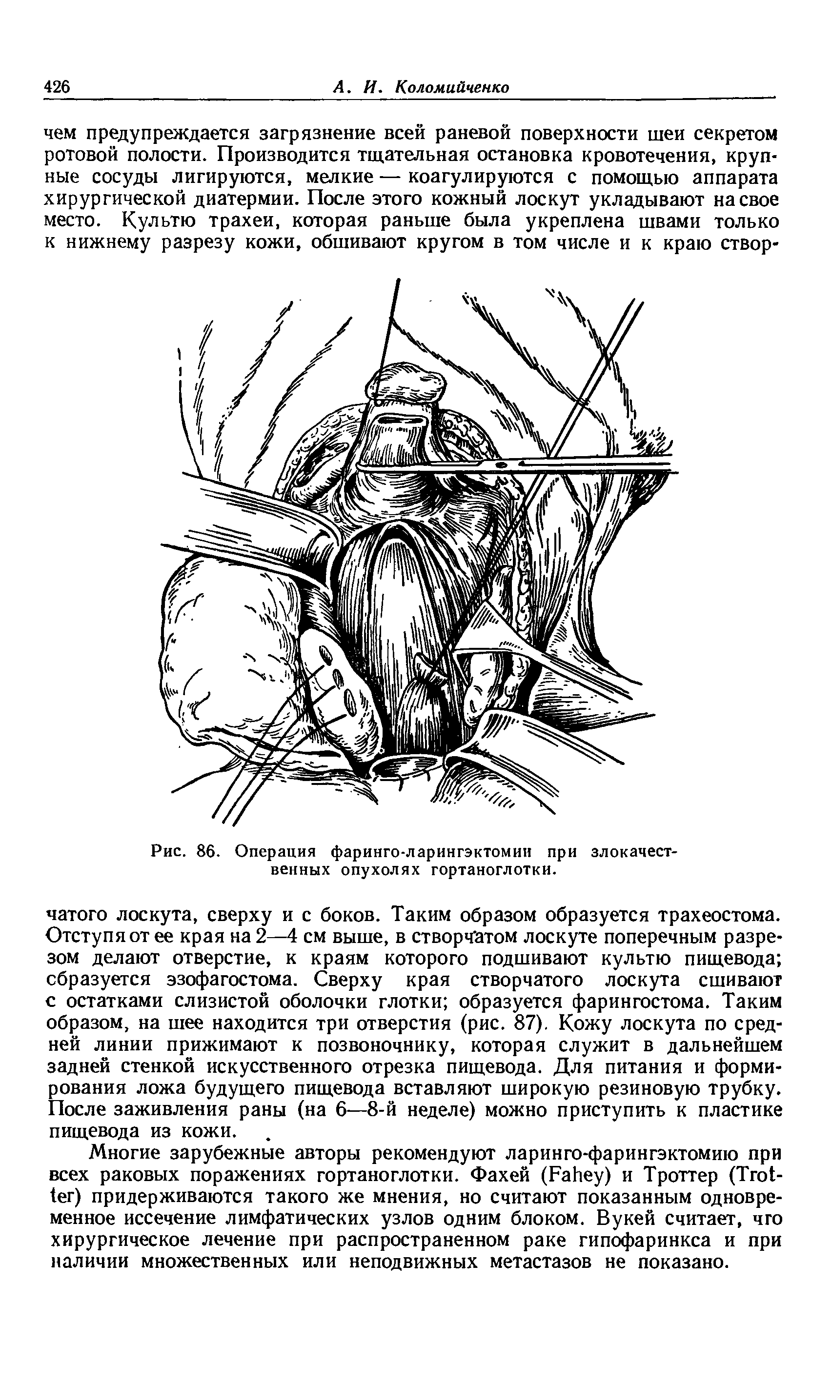 Рис. 86. Операция фаринго-ларингэктомии при злокачественных опухолях гортаноглотки.