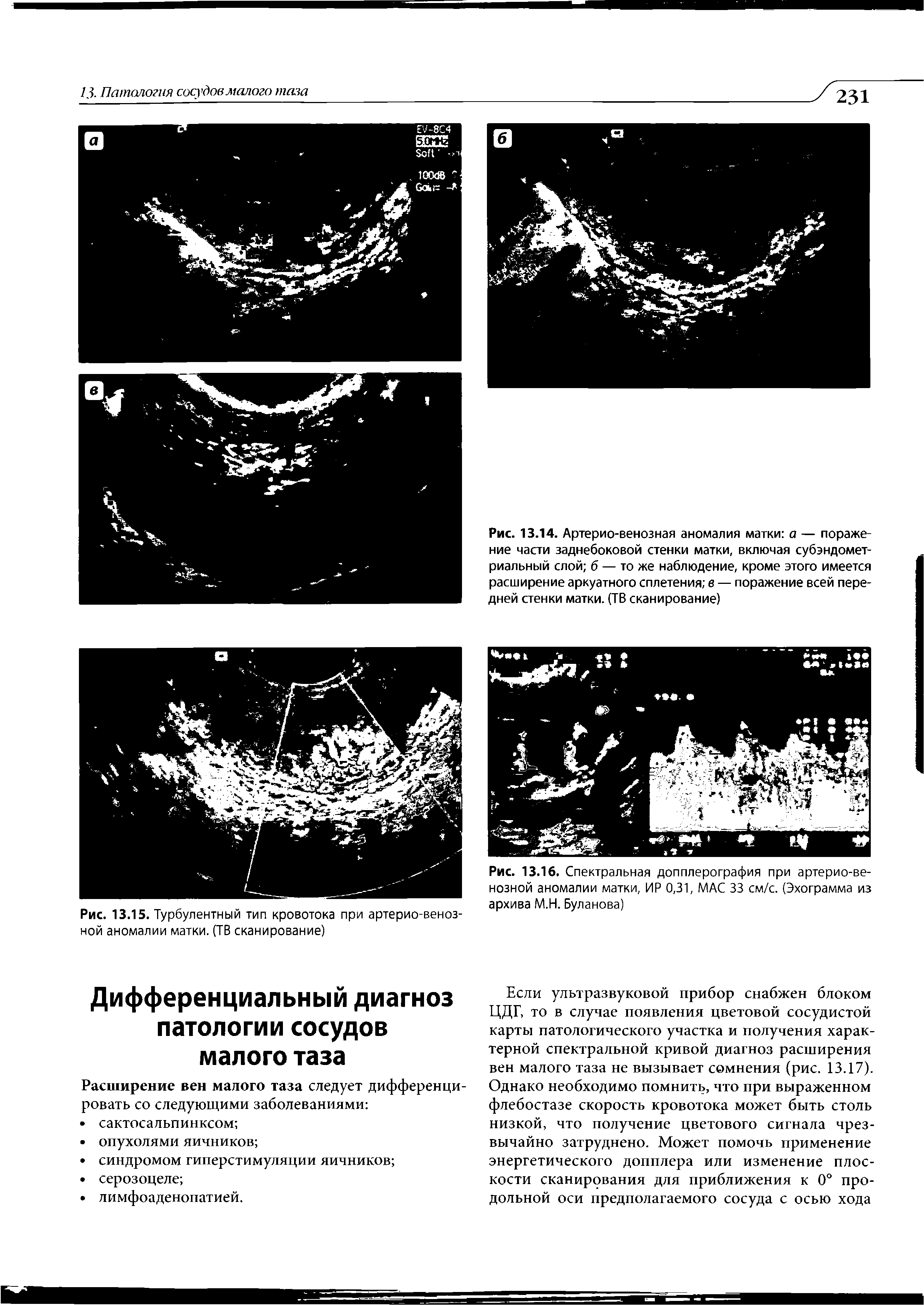 Рис. 13.15. Турбулентный тип кровотока при артерио-венозной аномалии матки. (ТВ сканирование)...