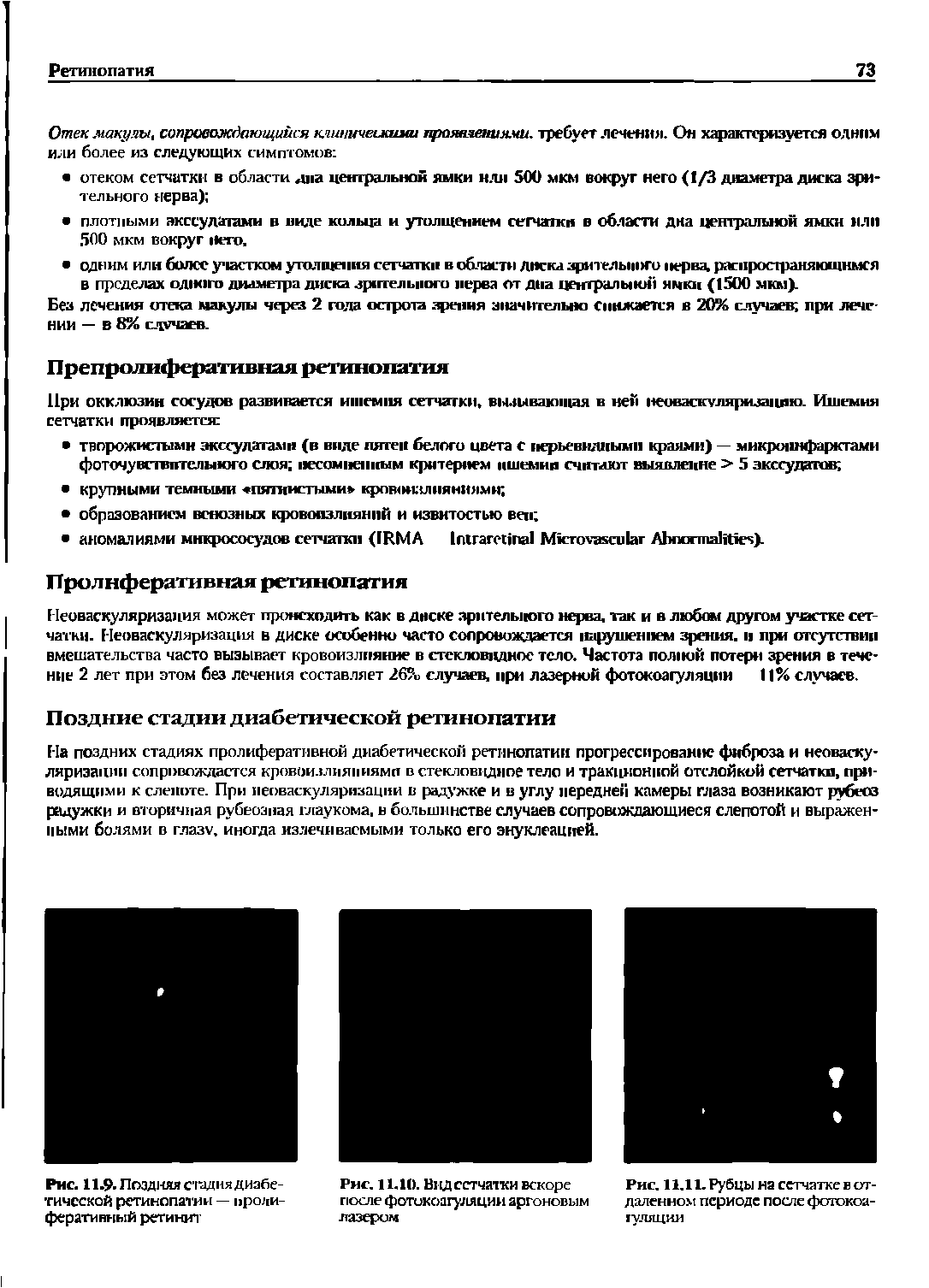 Рис. 11.11. Рубцы на сетчатке в отдаленном периоде после феггокоа-гуляции...