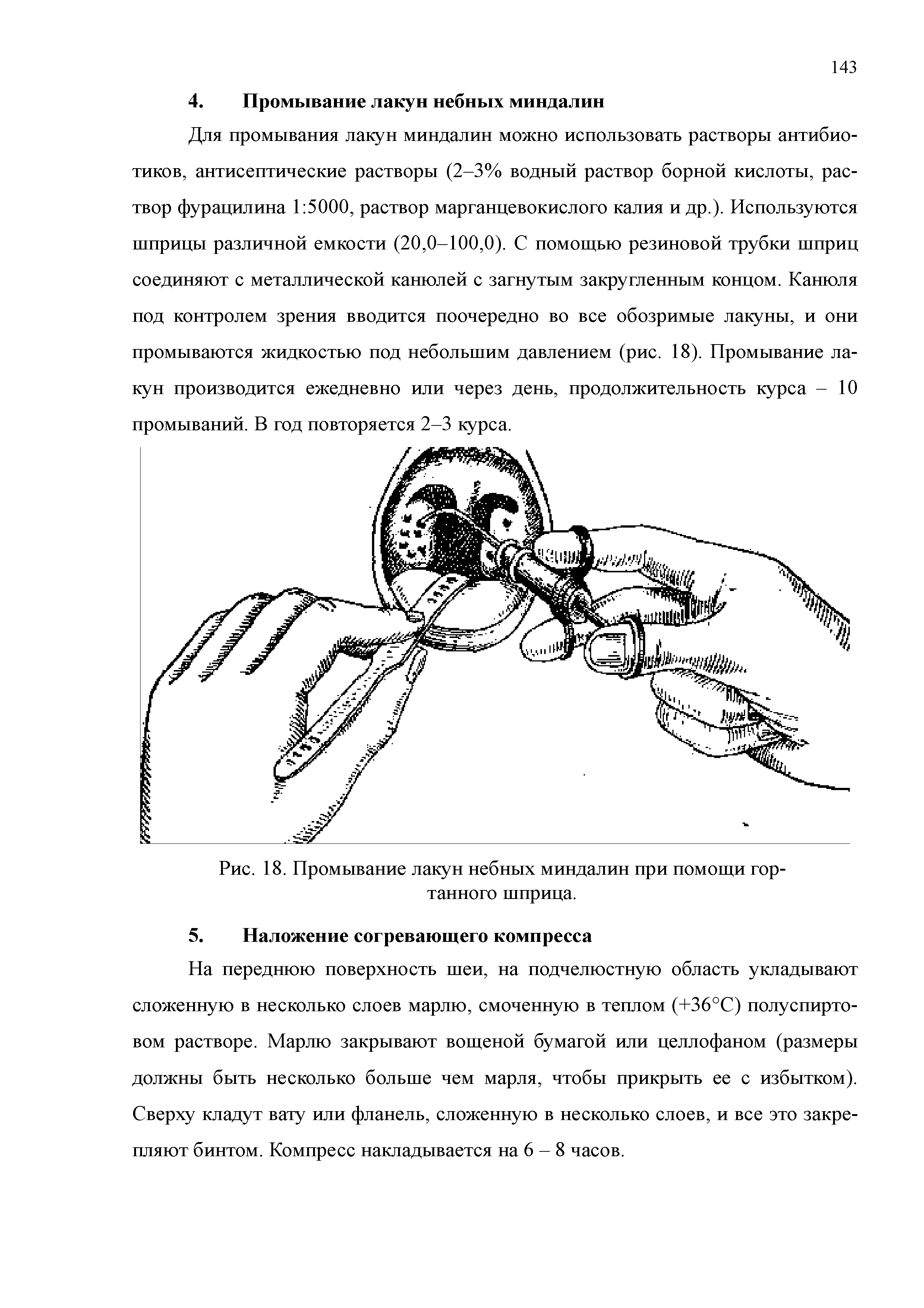 Рис. 18. Промывание лакун небных миндалин при помощи гортанного шприца.