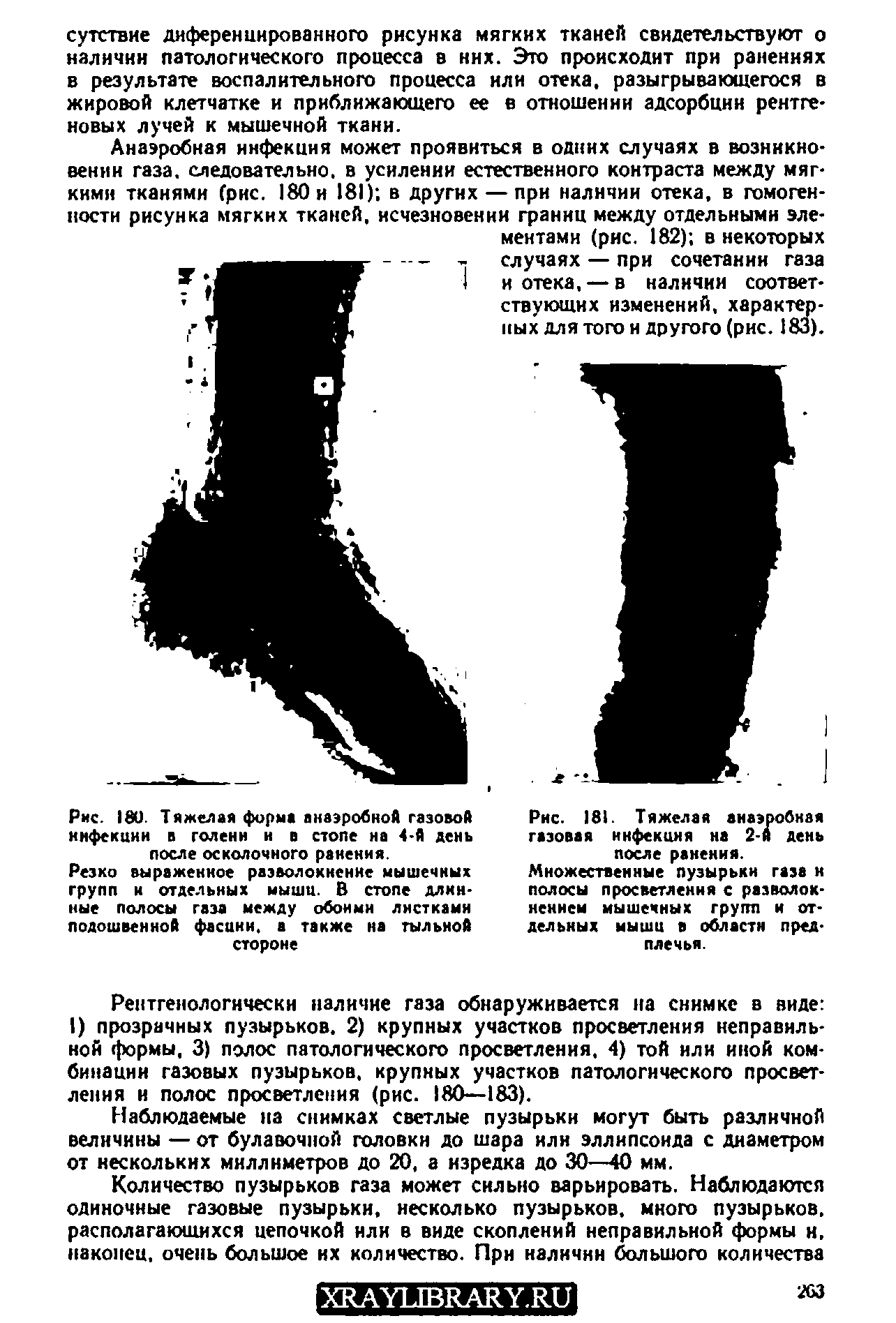 Рис. 181. Тяжелая анаэробная газовая инфекция на 2-й день после ранения.