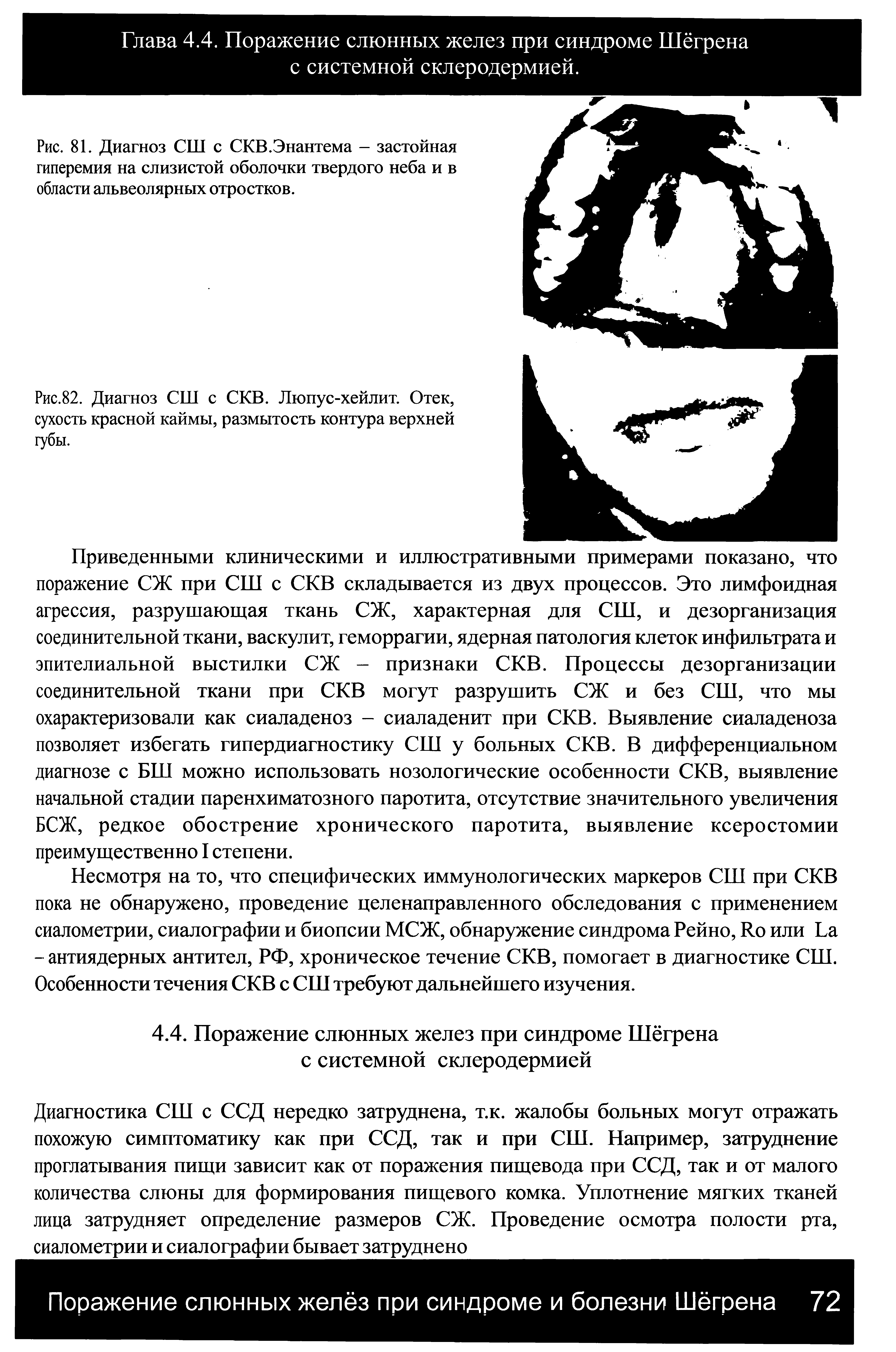 Рис.82. Диагноз СШ с СКВ. Люпус-хейлит. Отек, сухость красной каймы, размытость контура верхней губы.