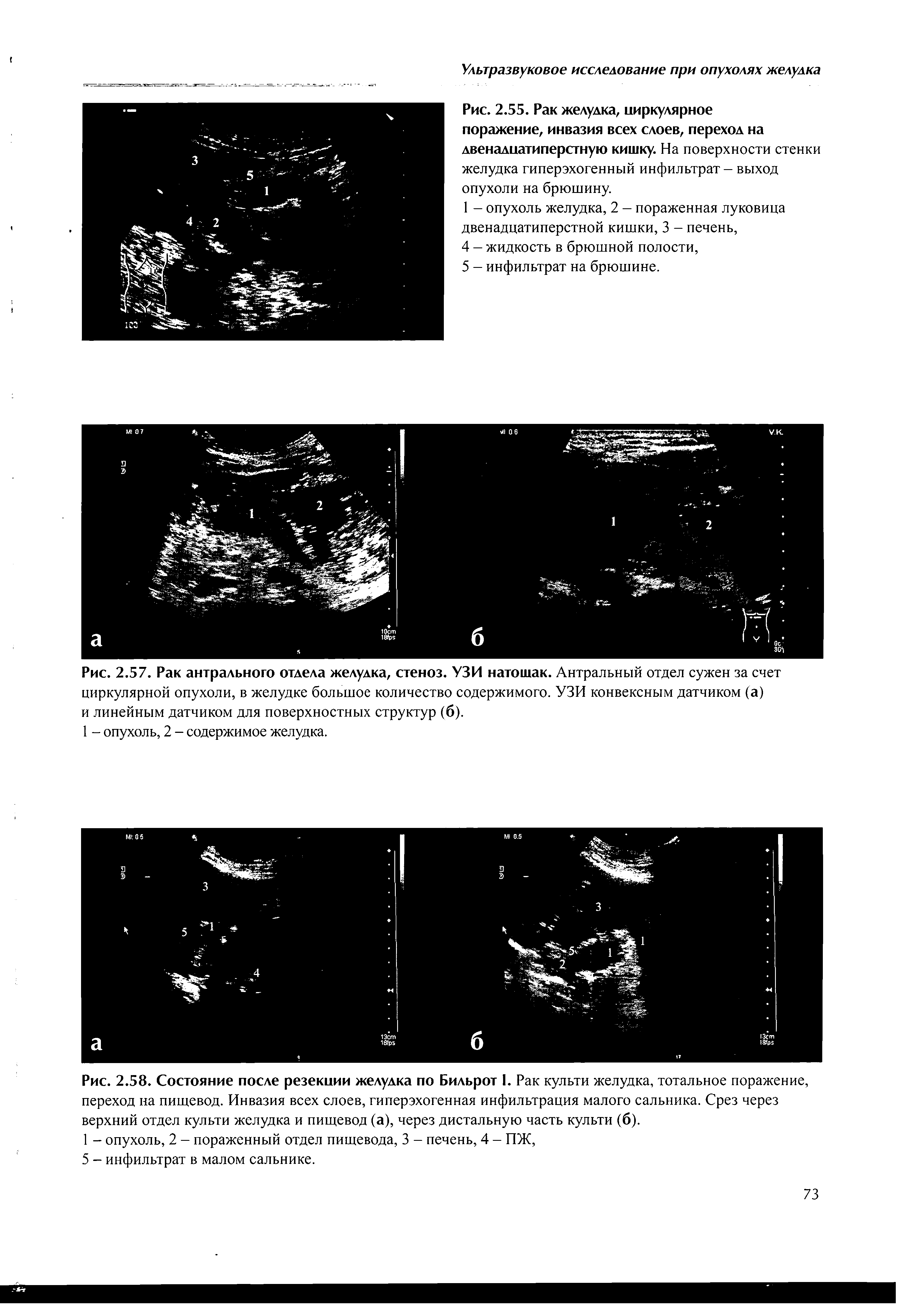 Рис. 2.58. Состояние после резекции желудка по Бильрот I. Рак культи желудка, тотальное поражение, переход на пищевод. Инвазия всех слоев, гиперэхогенная инфильтрация малого сальника. Срез через верхний отдел культи желудка и пищевод (а), через дистальную часть культи (б).