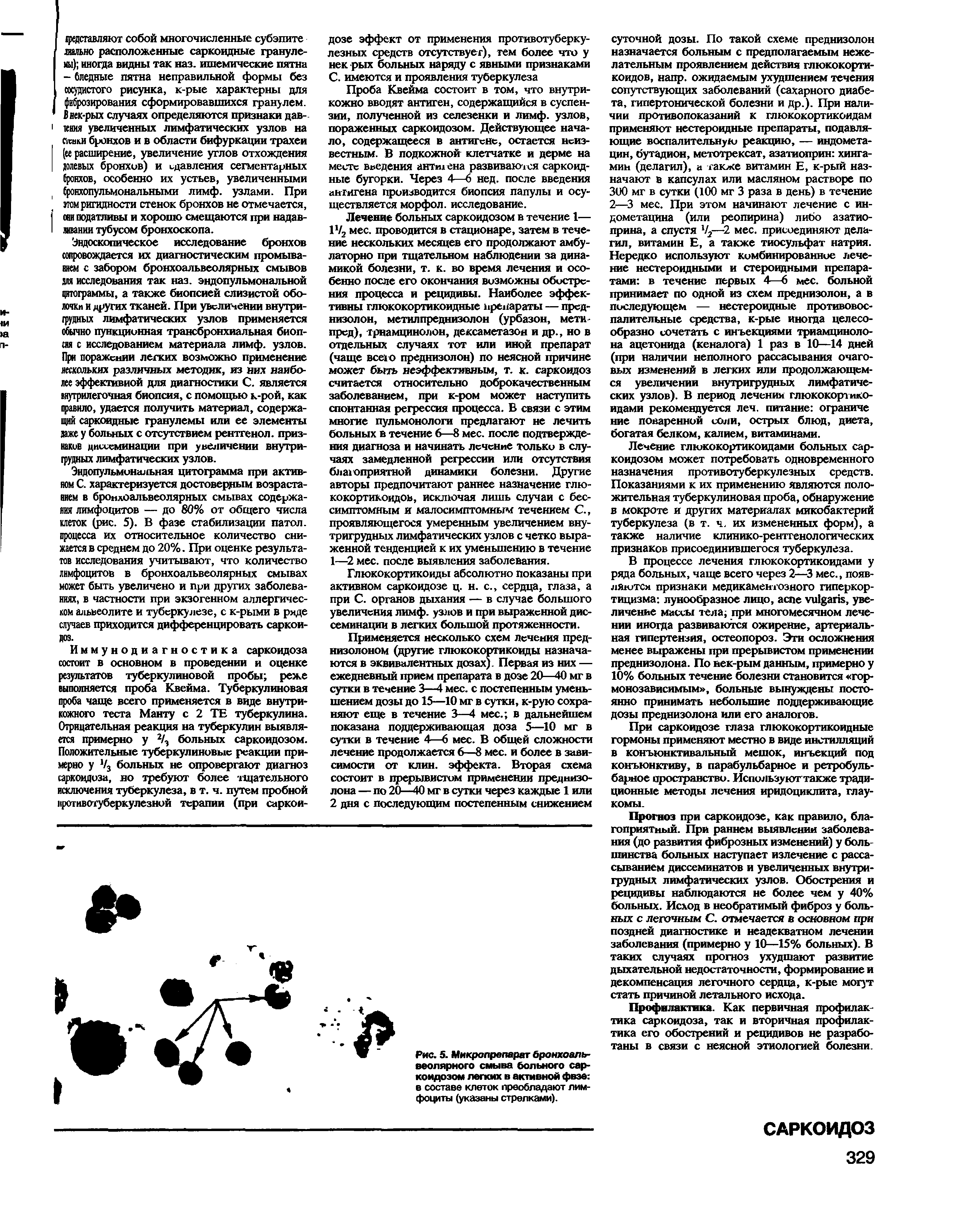 Рис. 5. Микропреларат бронхоальвеолярного смыва больного саркоидозом легких в активной фвэе в составе клеток преобладают лимфоциты (указаны стрелками).