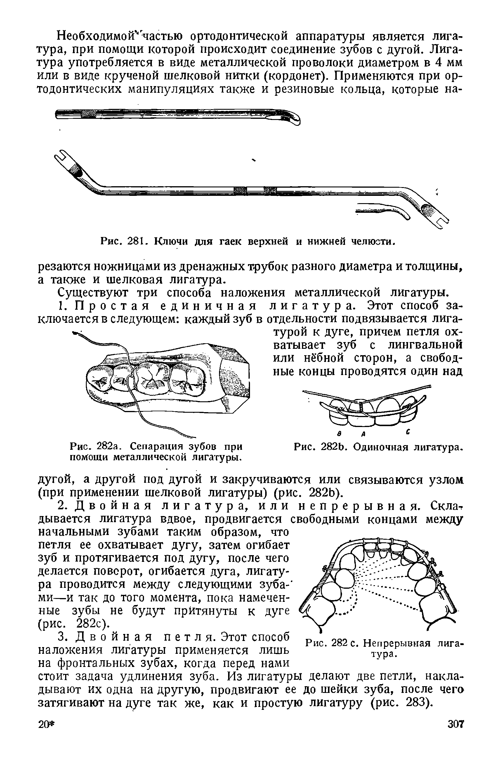 Рис. 282а. Сепарация зубов при помощи металлической лигатуры.