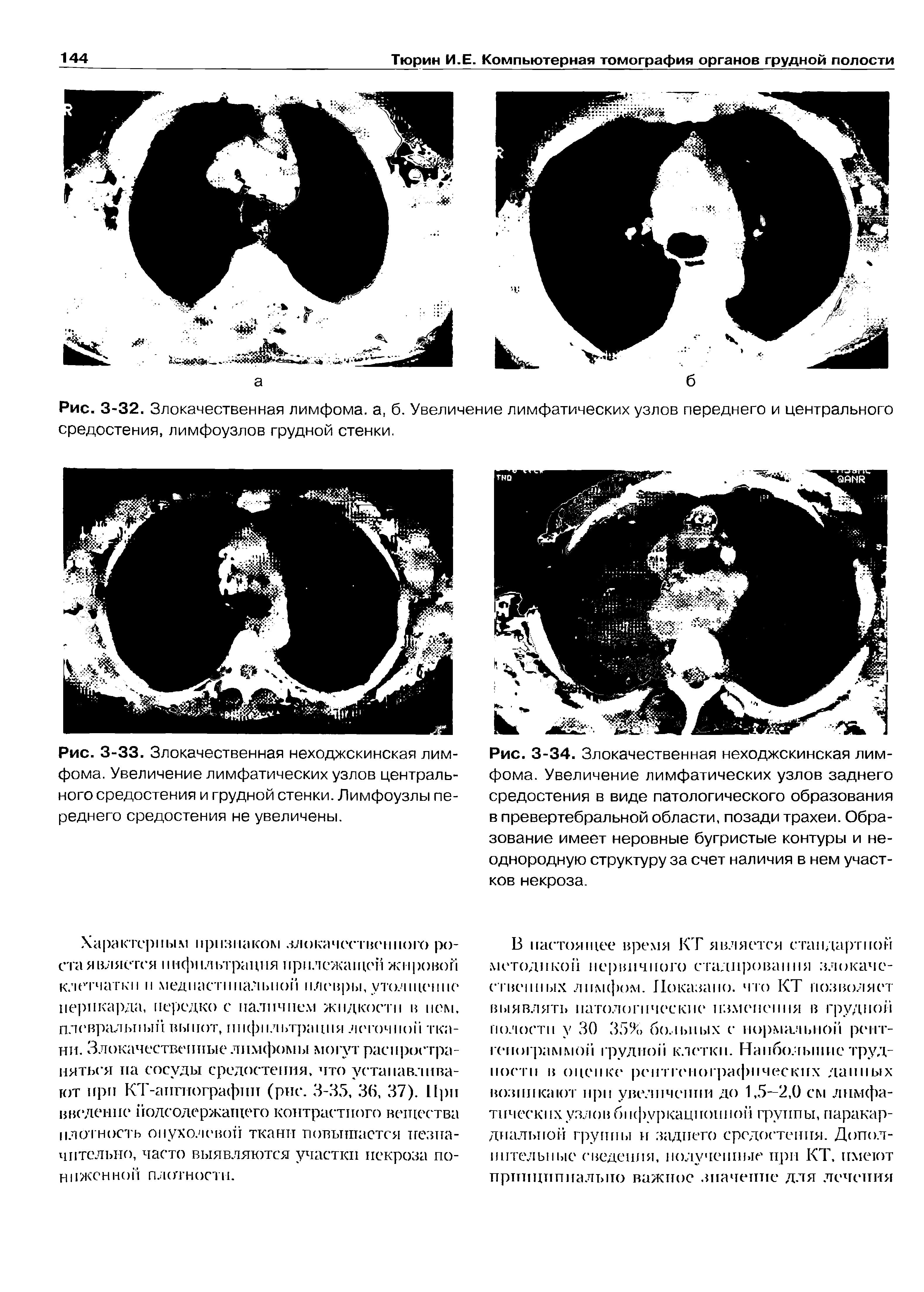 Рис. 3-33. Злокачественная неходжскинская лимфома. Увеличение лимфатических узлов центрального средостения и грудной стенки. Лимфоузлы переднего средостения не увеличены.