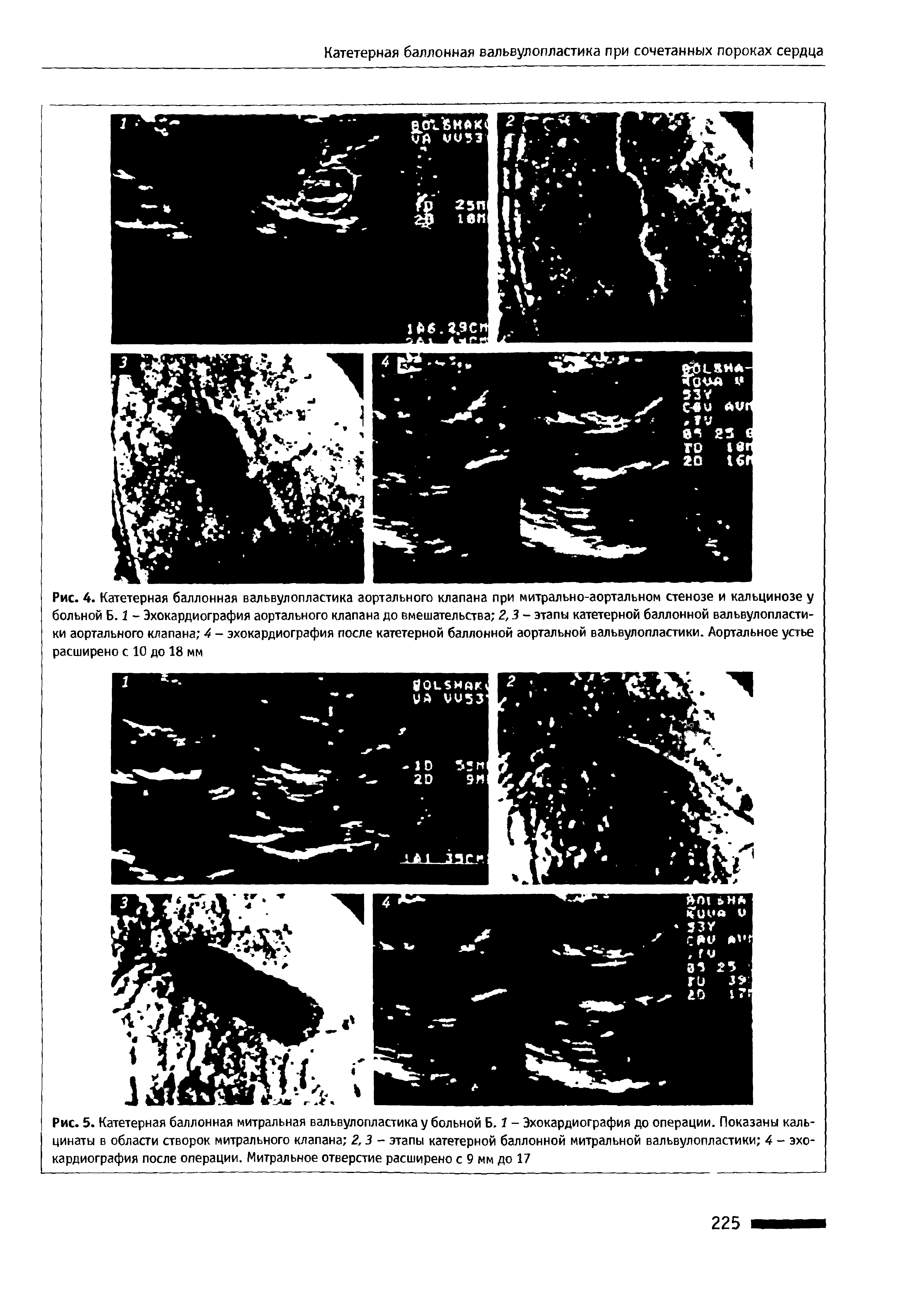 Рис. 5. Катетерная баллонная митральная вальвулопластика у больной Б. 1 - Эхокардиография до операции. Показаны каль-цинаты в области створок митрального клапана 2,3 - этапы катетерной баллонной митральной вальвулопластики 4 - эхокардиография после операции. Митральное отверстие расширено с 9 мм до 17...
