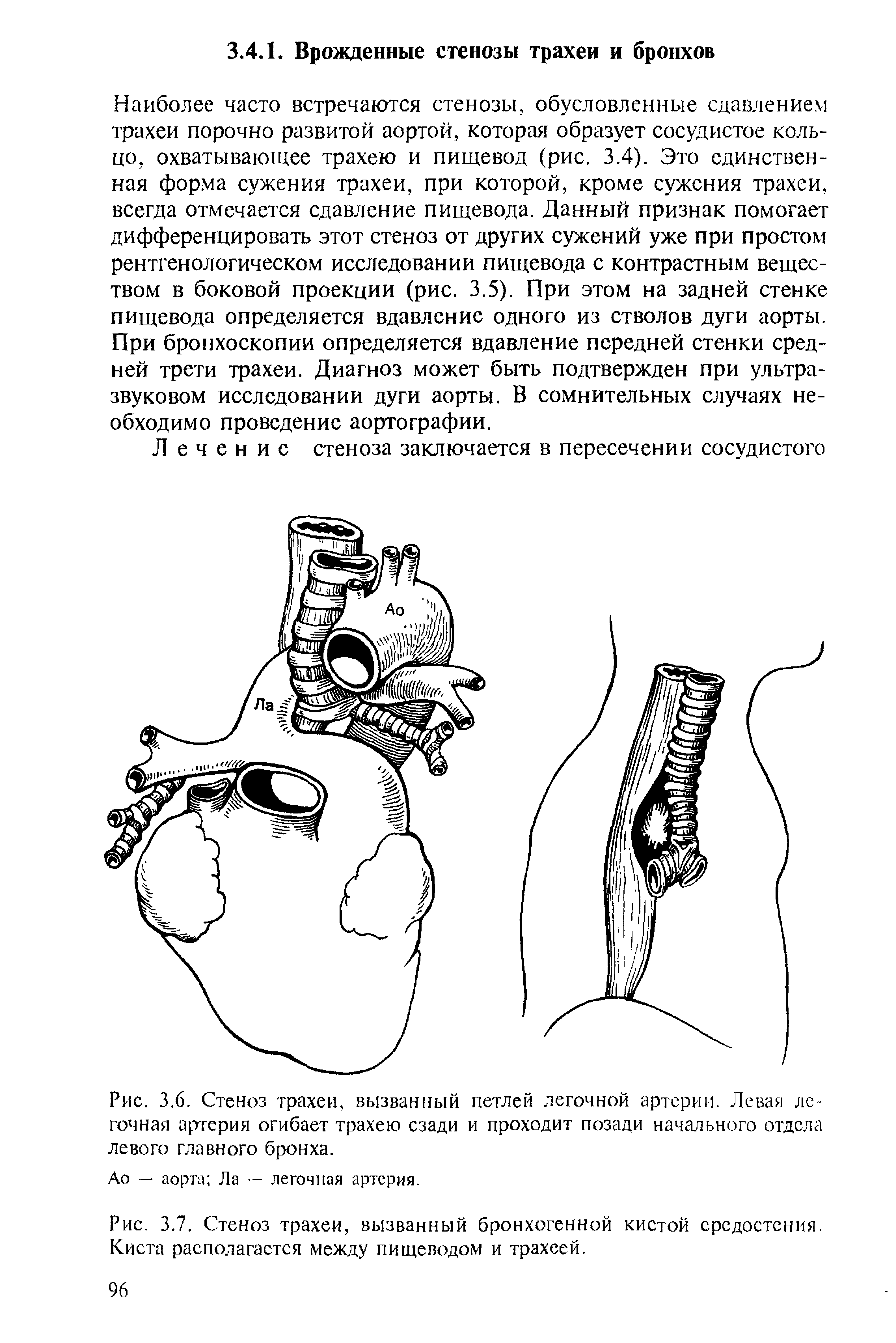 Рис. 3.6. Стеноз трахеи, вызванный петлей легочной артерии. Левая легочная артерия огибает трахею сзади и проходит позади начального отдела левого главного бронха.