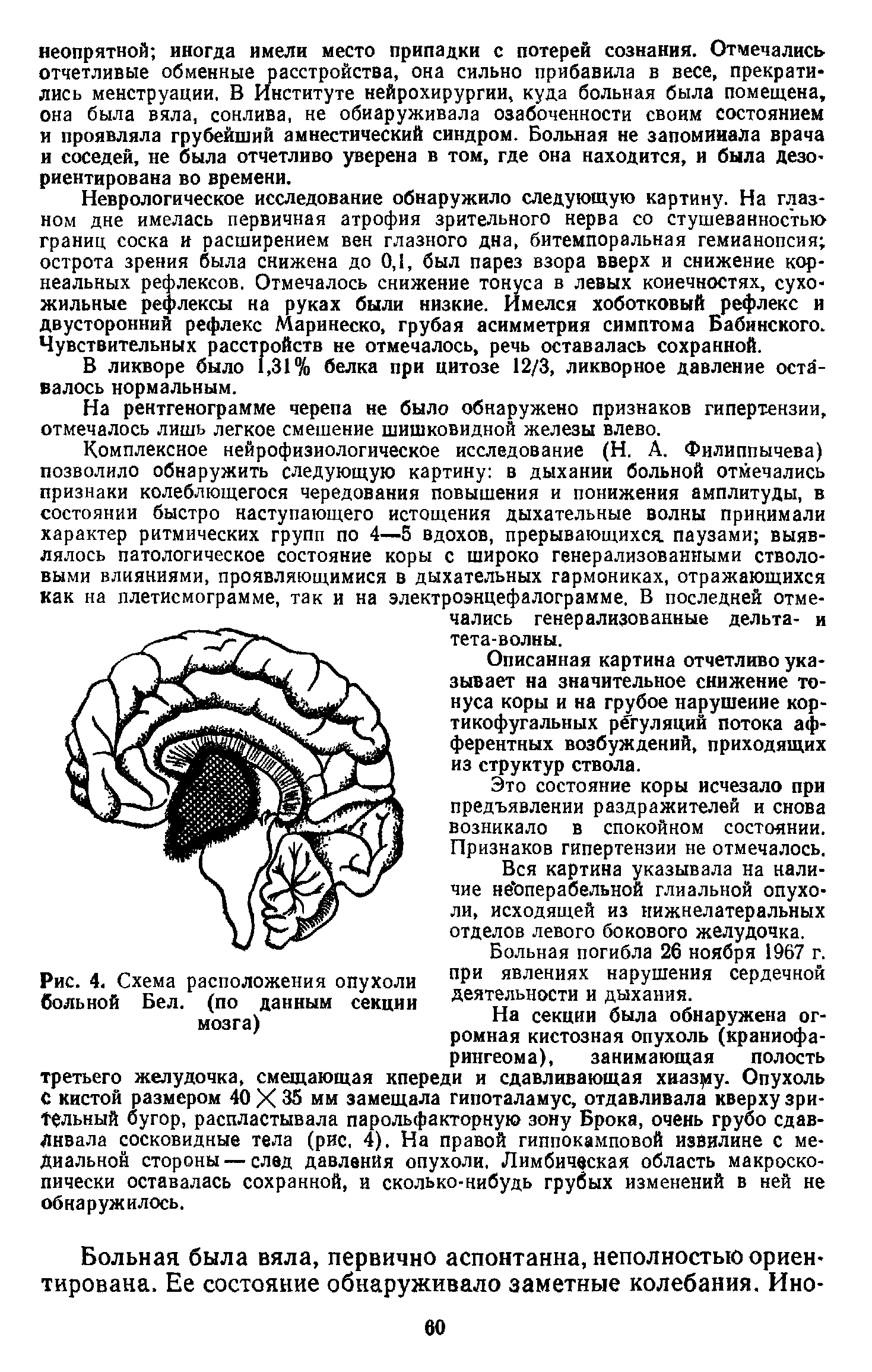 Рис. 4, Схема расположения опухоли больной Бел. (по данным секции мозга)...