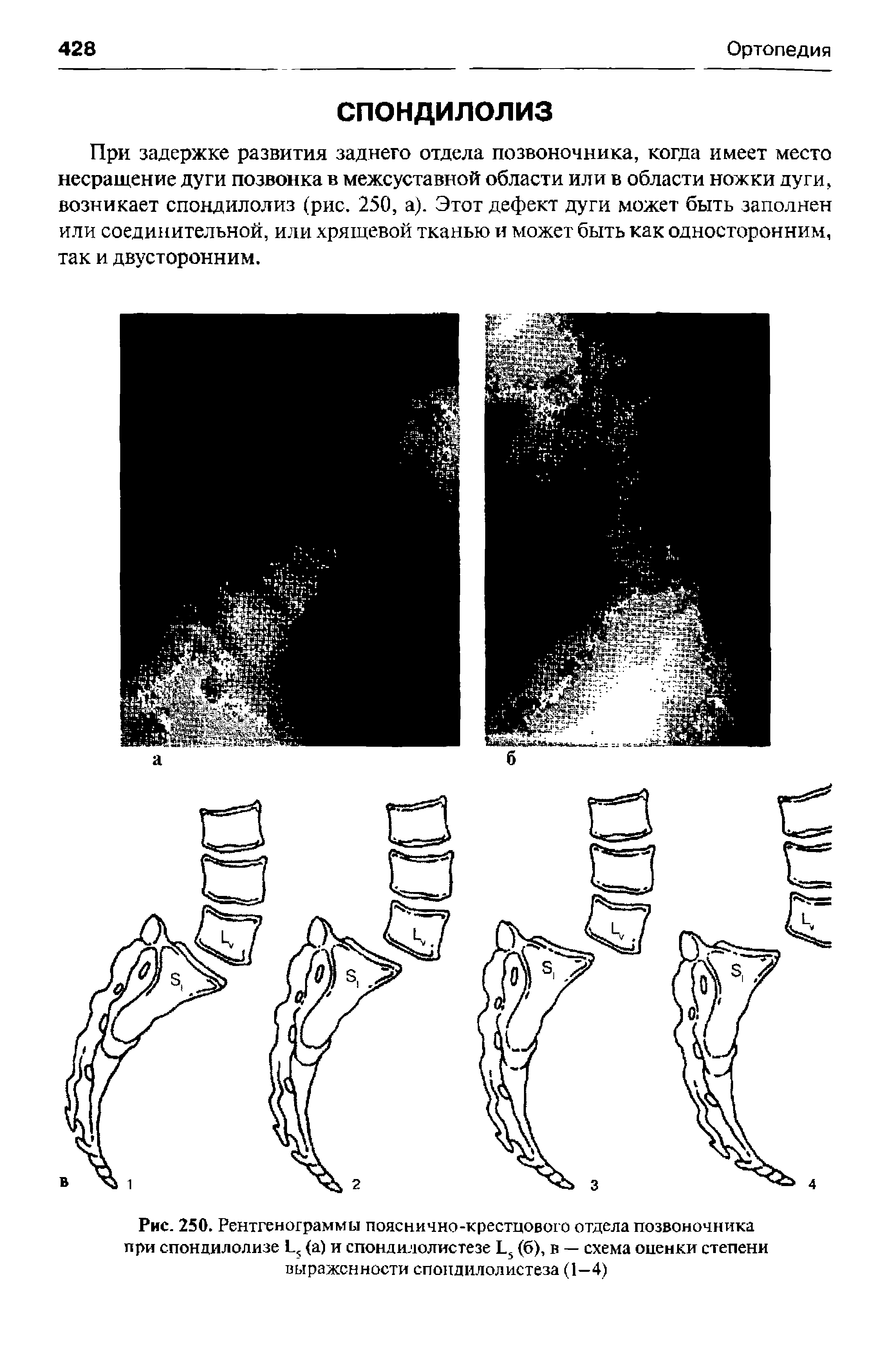Рис. 250. Рентгенограммы пояснично-крестцового отдела позвоночника при спондилолизе 1., (а) и спондилолистезе 1.5 (б), в — схема оценки степени выраженности спондилолистеза (1—4)...