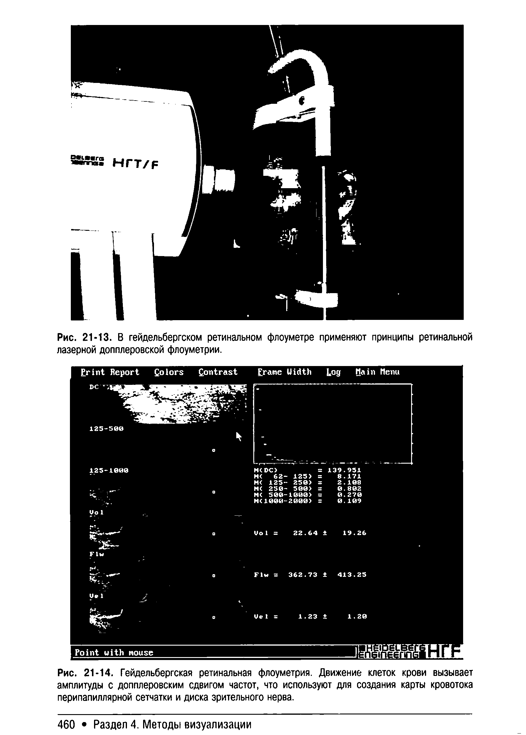 Рис. 21-14. Гейдельбергская ретинальная флоуметрия. Движение клеток крови вызывает амплитуды с допплеровским сдвигом частот, что используют для создания карты кровотока перипапиллярной сетчатки и диска зрительного нерва.