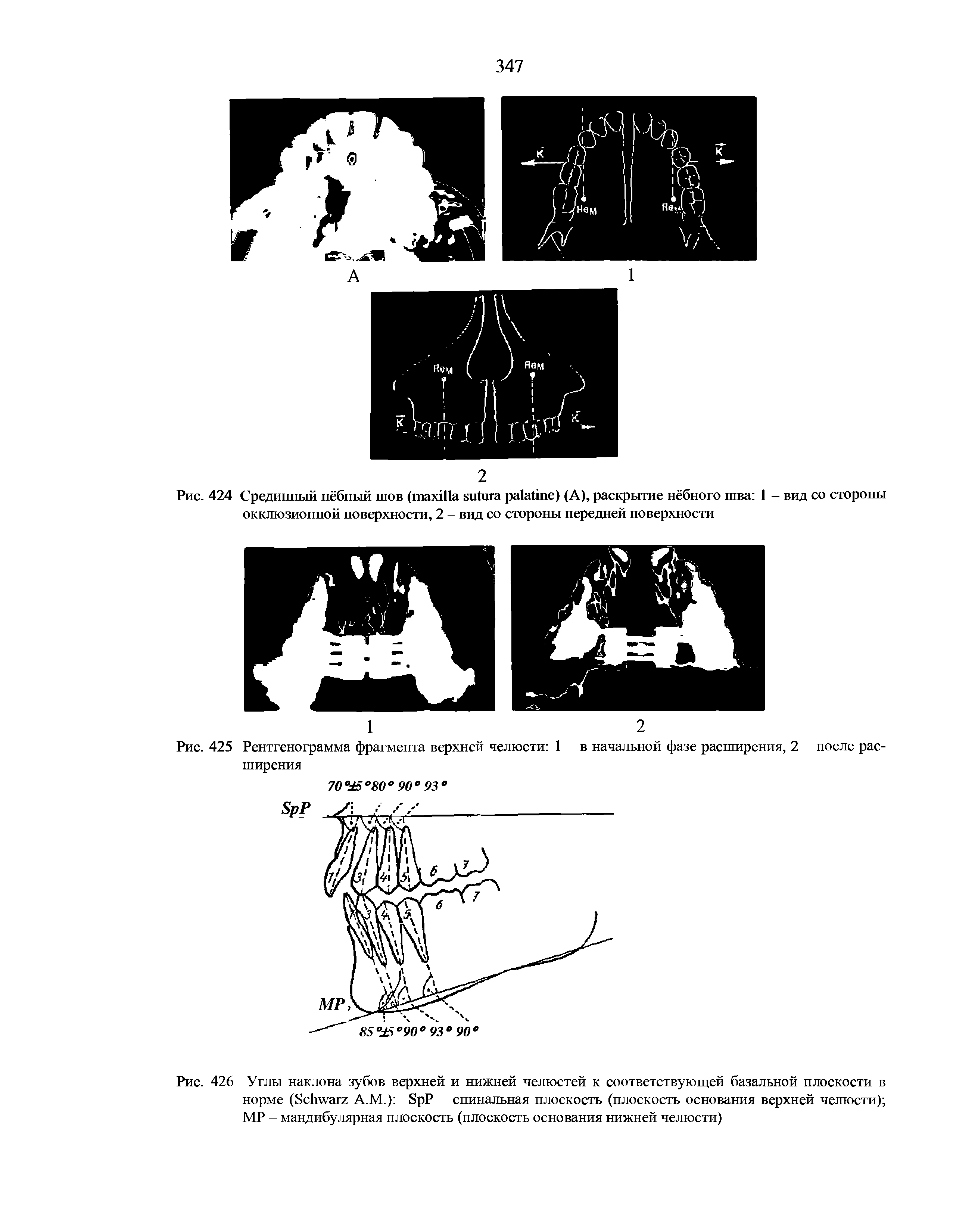 Рис. 426 Углы наклона зубов верхней и нижней челюстей к соответствующей базальной плоскости в норме (S А.М.) S P спинальная плоскость (плоскость основания верхней челюсти) МР - мандибулярная плоскость (плоскость основания нижней челюсти)...