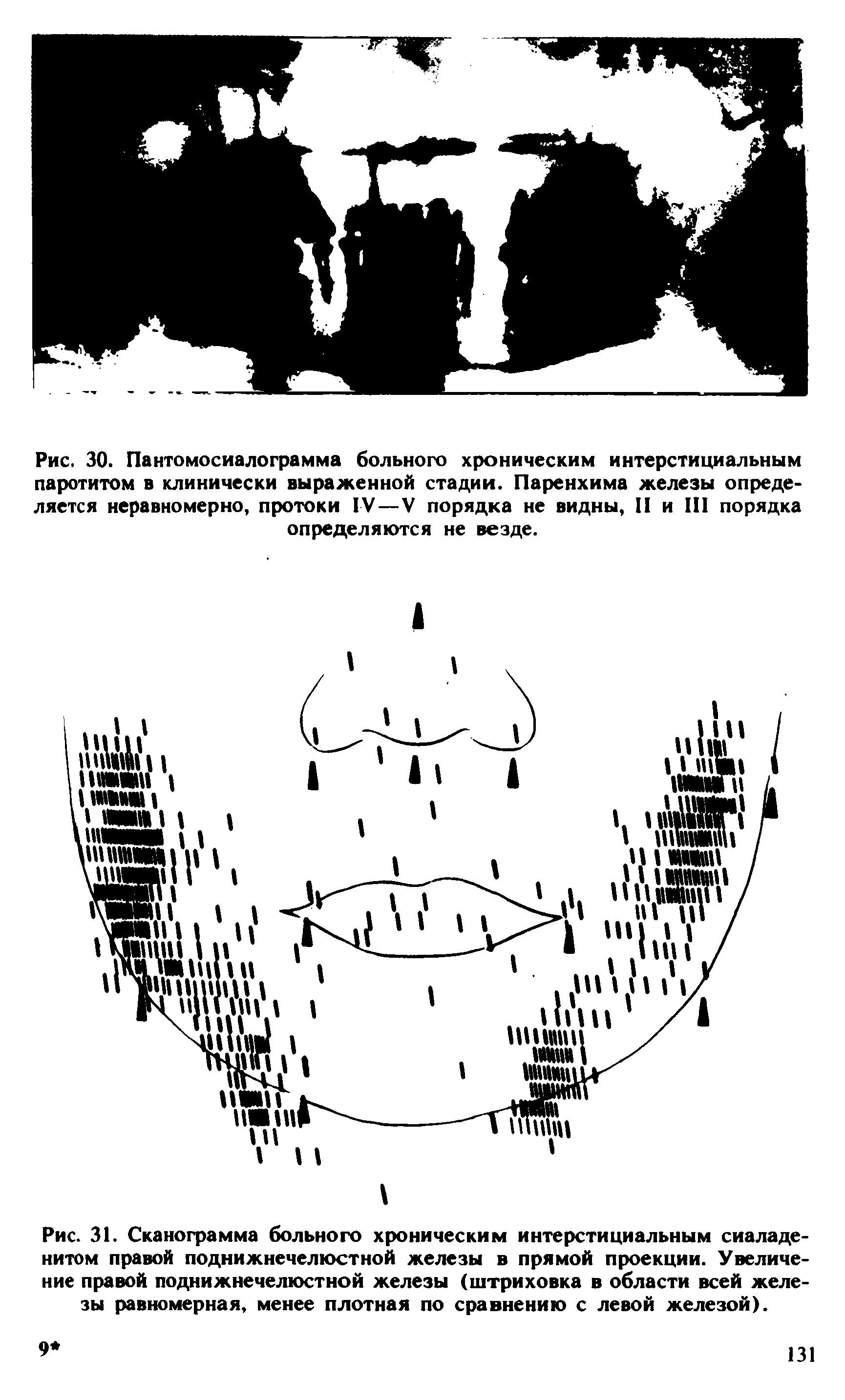 Рис. 31. Сканограмма больного хроническим интерстициальным сиаладе-нитом правой поднижнечелюстной железы в прямой проекции. Увеличение правой поднижнечелюстной железы (штриховка в области всей железы равномерная, менее плотная по сравнению с левой железой).