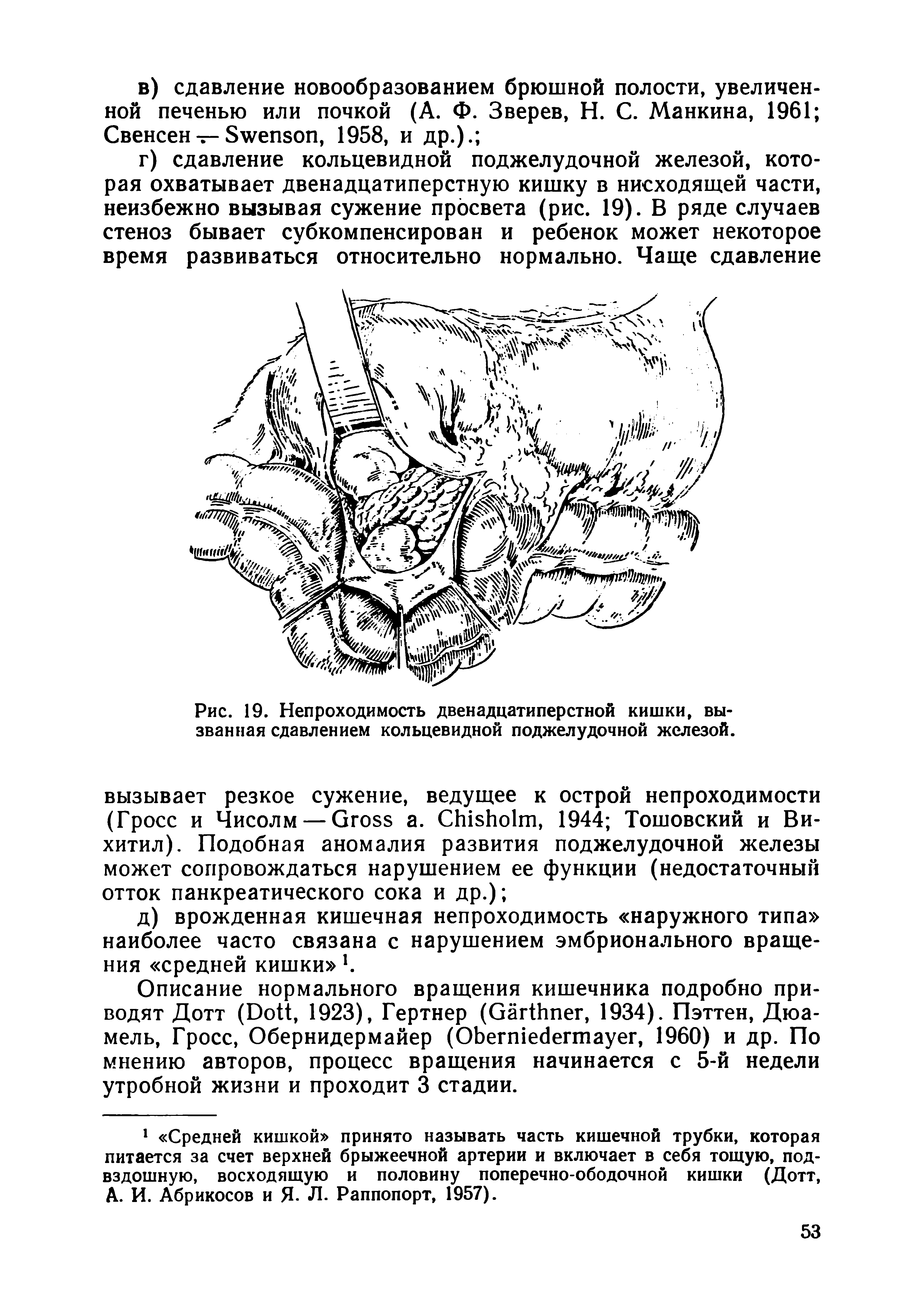 Рис. 19. Непроходимость двенадцатиперстной кишки, вызванная сдавлением кольцевидной поджелудочной железой.