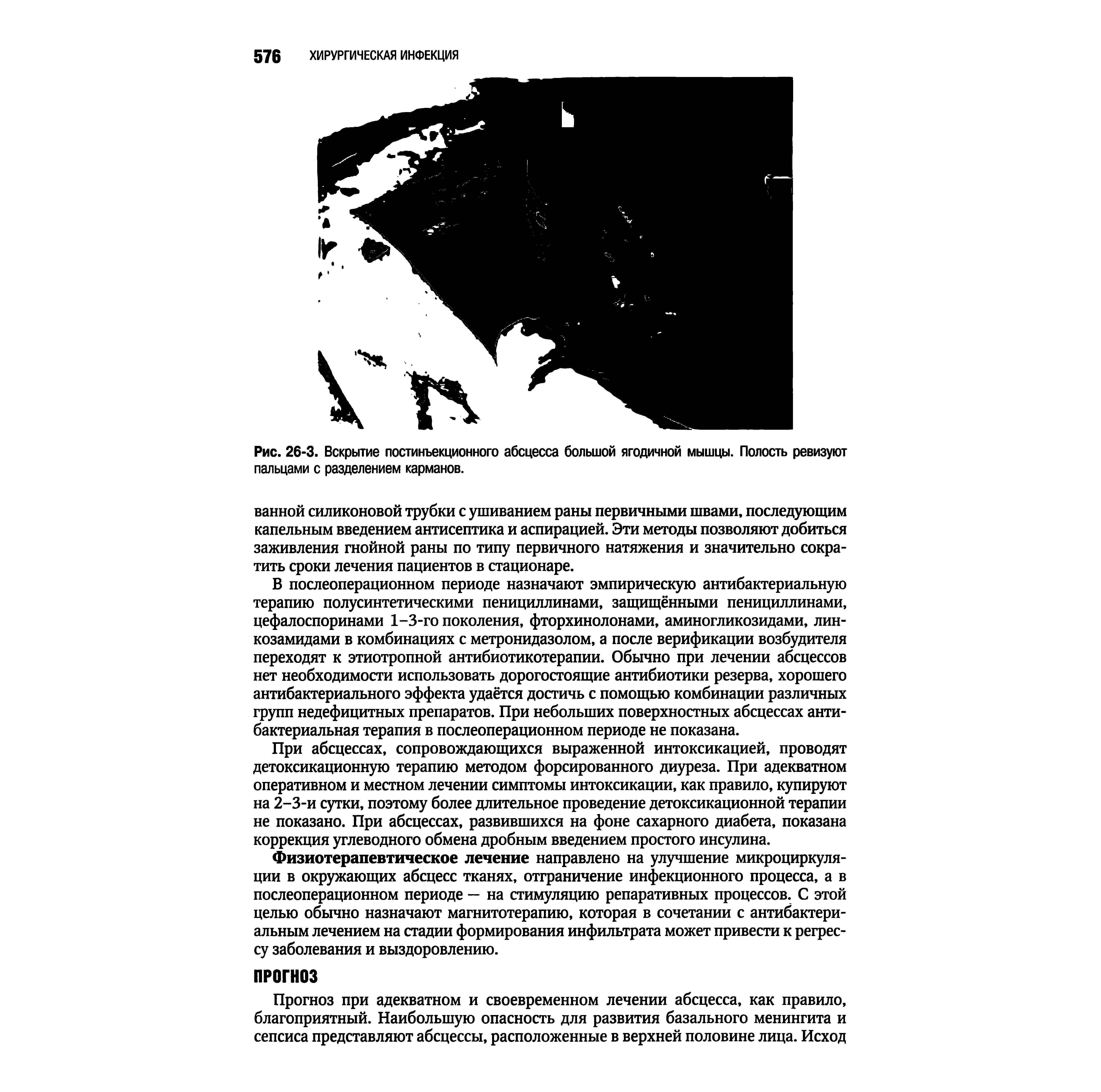 Рис. 26-3. Вскрытие постинъекционного абсцесса большой ягодичной мышцы. Полость ревизуют пальцами с разделением карманов.