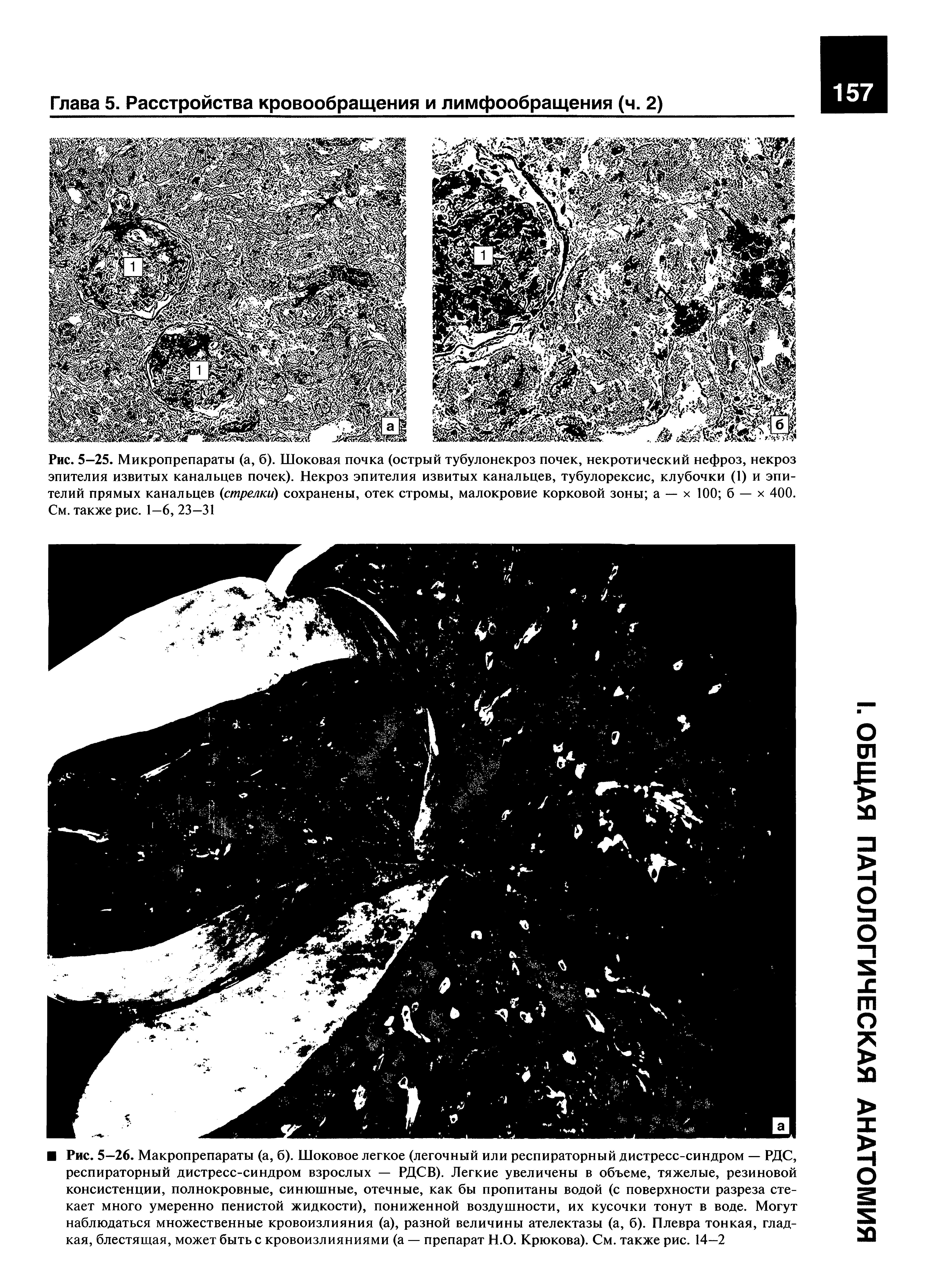 Рис. 5-25. Микропрепараты (а, б). Шоковая почка (острый тубулонекроз почек, некротический нефроз, некроз эпителия извитых канальцев почек). Некроз эпителия извитых канальцев, тубулорексис, клубочки (1) и эпителий прямых канальцев (стрелки) сохранены, отек стромы, малокровие корковой зоны а — х 100 б — х 400. См. также рис. 1—6, 23—31...