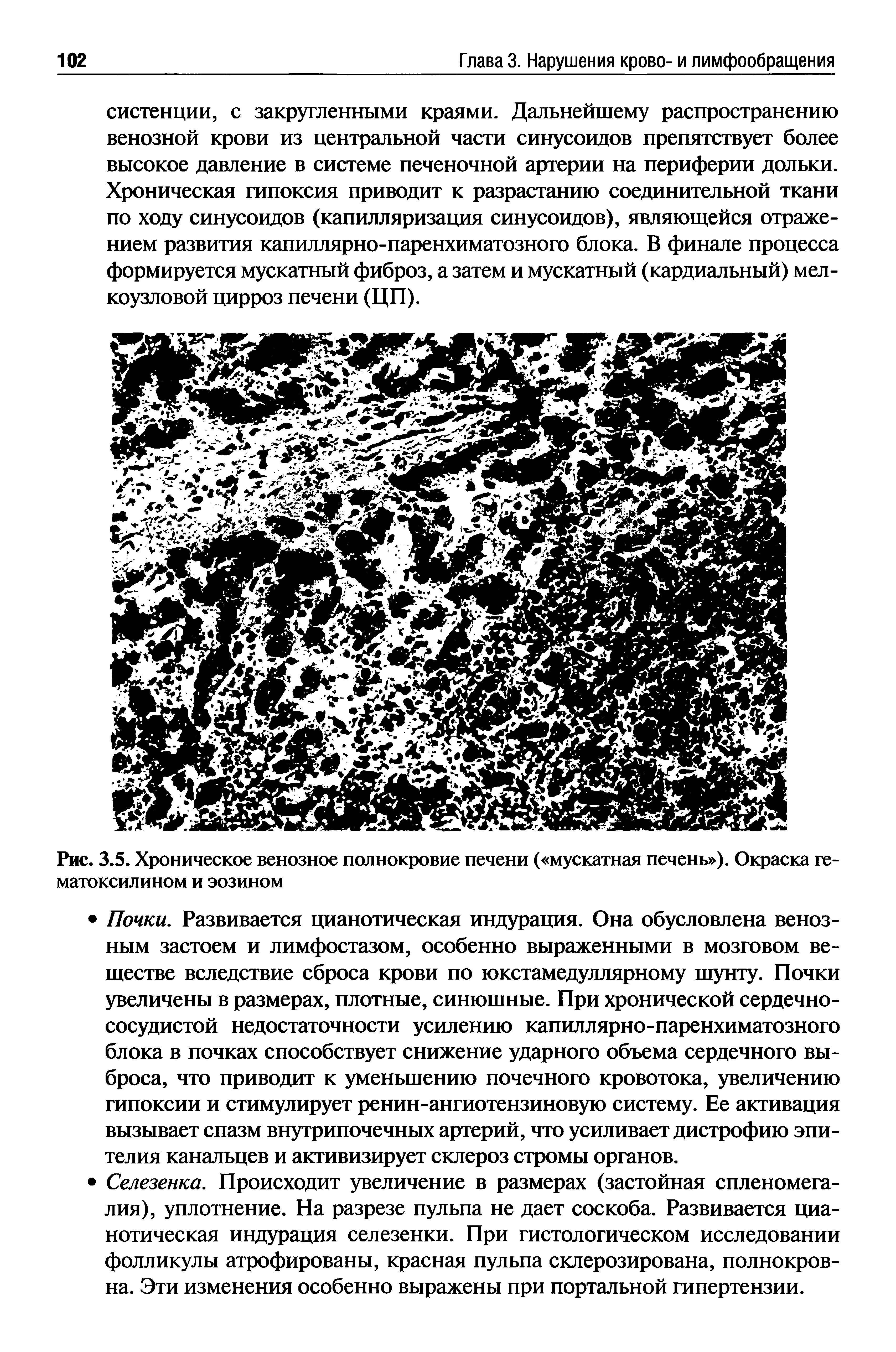 Рис. 3.5. Хроническое венозное полнокровие печени ( мускатная печень ). Окраска гематоксилином и эозином...