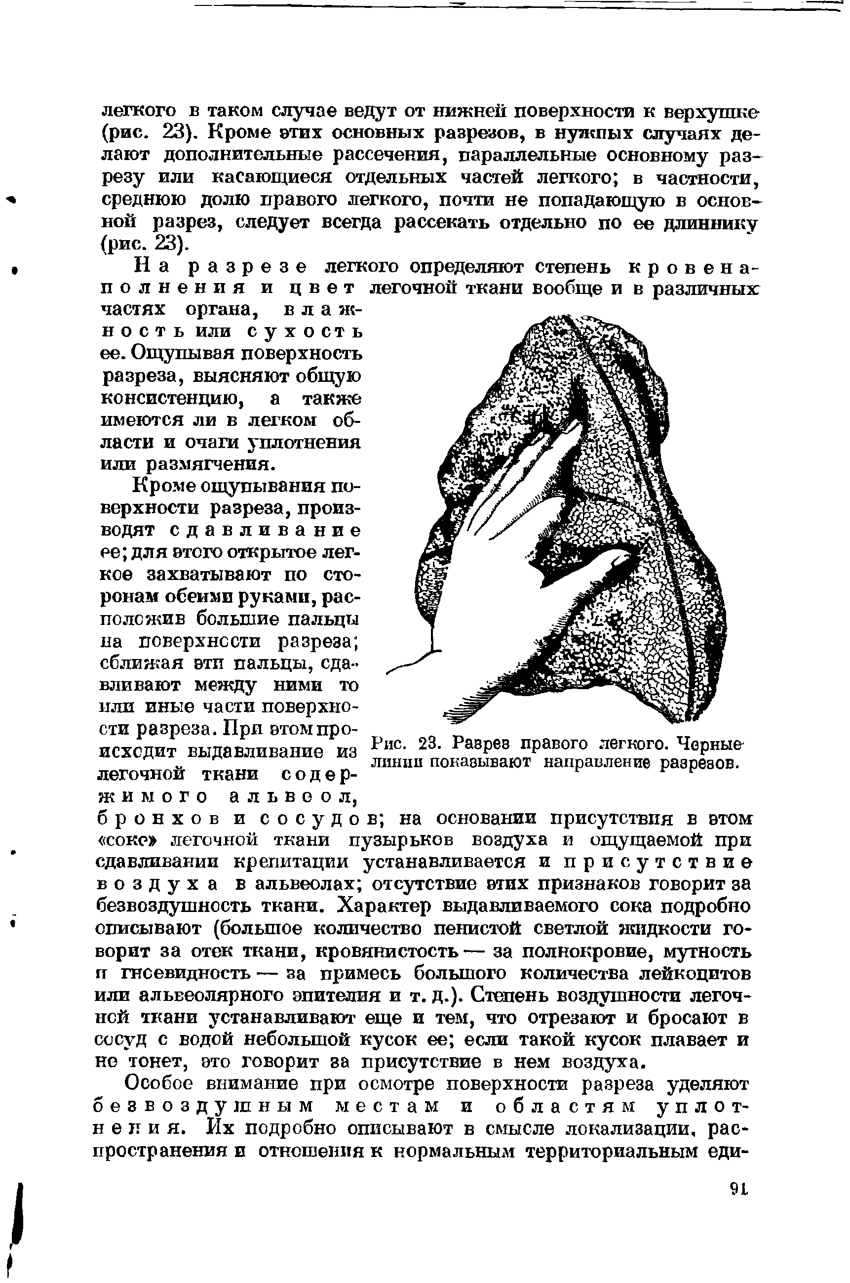 Рис. 23. Разрез правого легкого. Черные линии показывают направление разрезов.