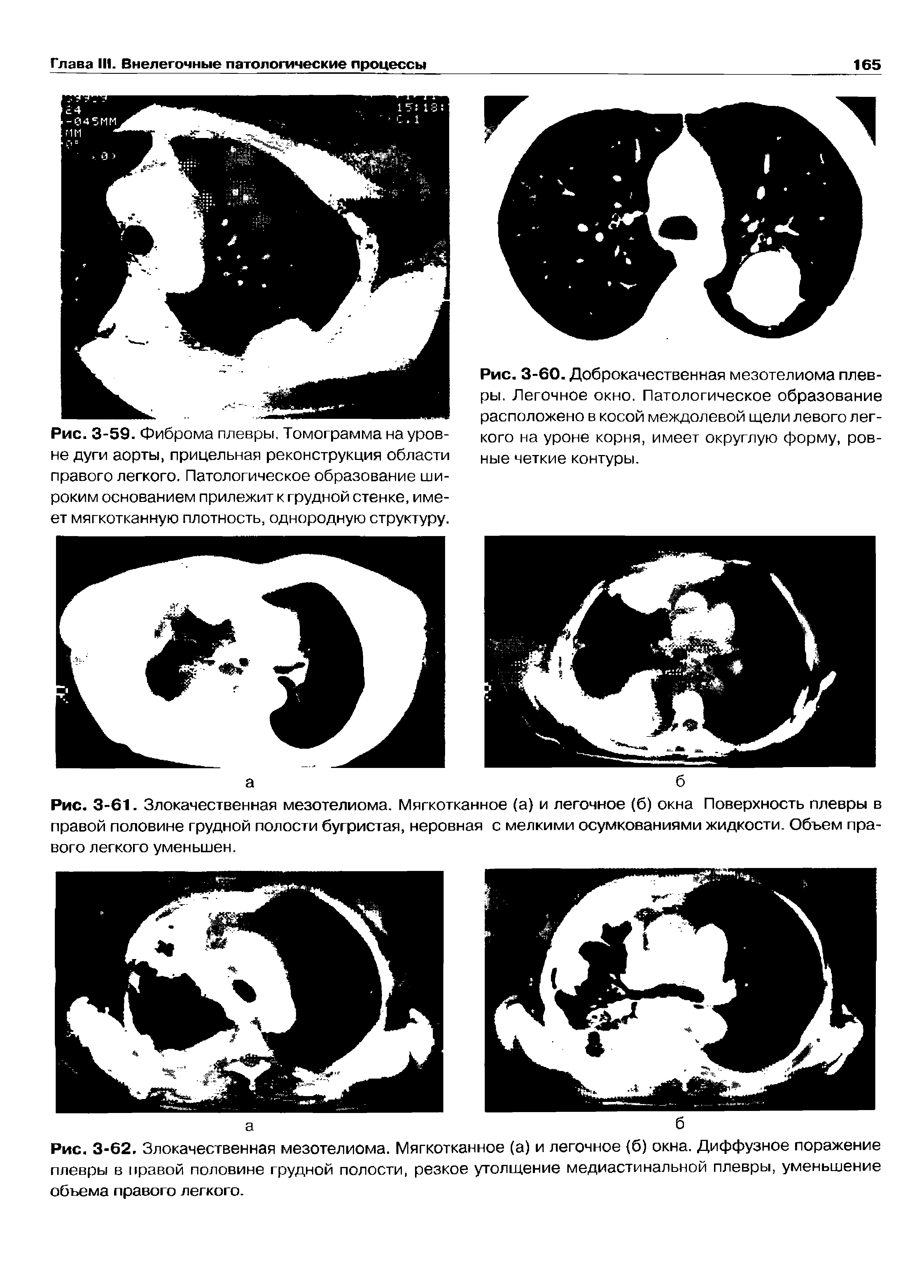 Рис. 3-61. Злокачественная мезотелиома. Мягкотканное (а) и легочное (б) окна Поверхность плевры в правой половине грудной полости бугристая, неровная с мелкими осумкованиями жидкости. Объем пра-...