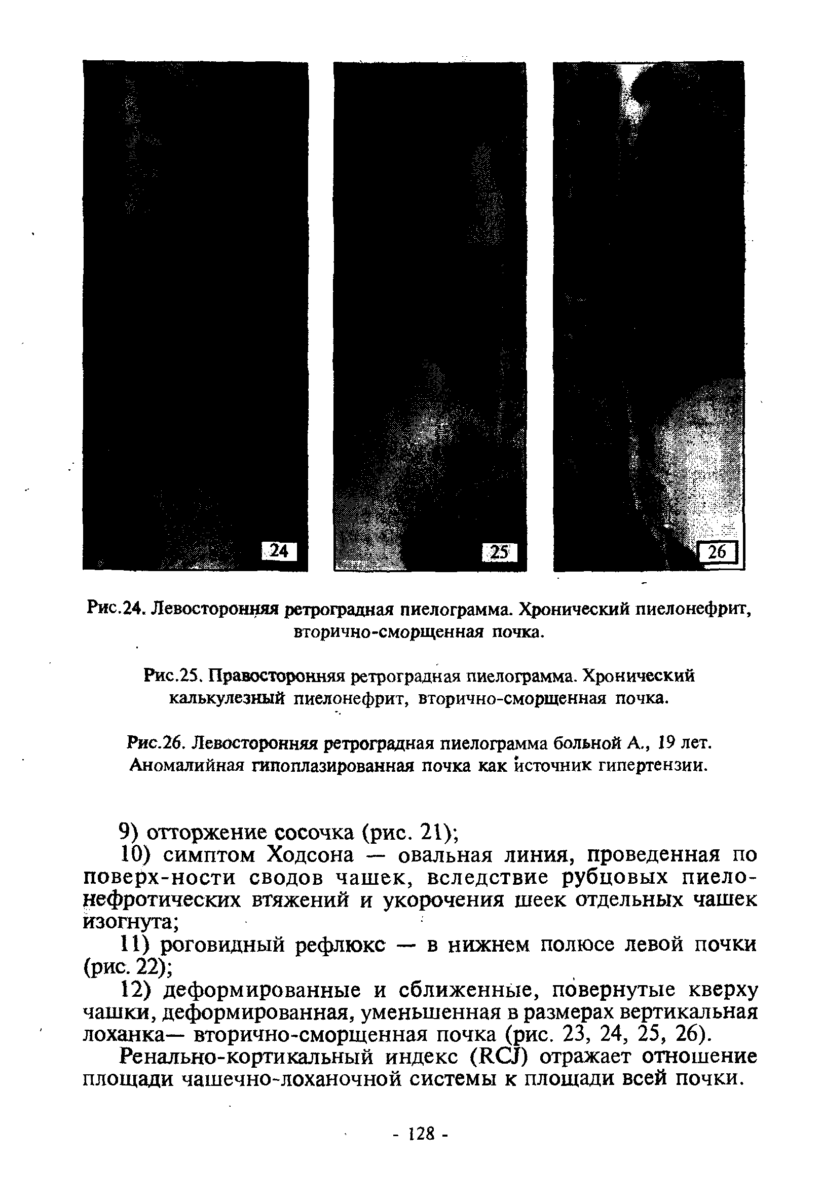 Рис.25. Правосторонняя ретроградная пиелограмма. Хронический калькулезный пиелонефрит, вторично-сморщенная почка.