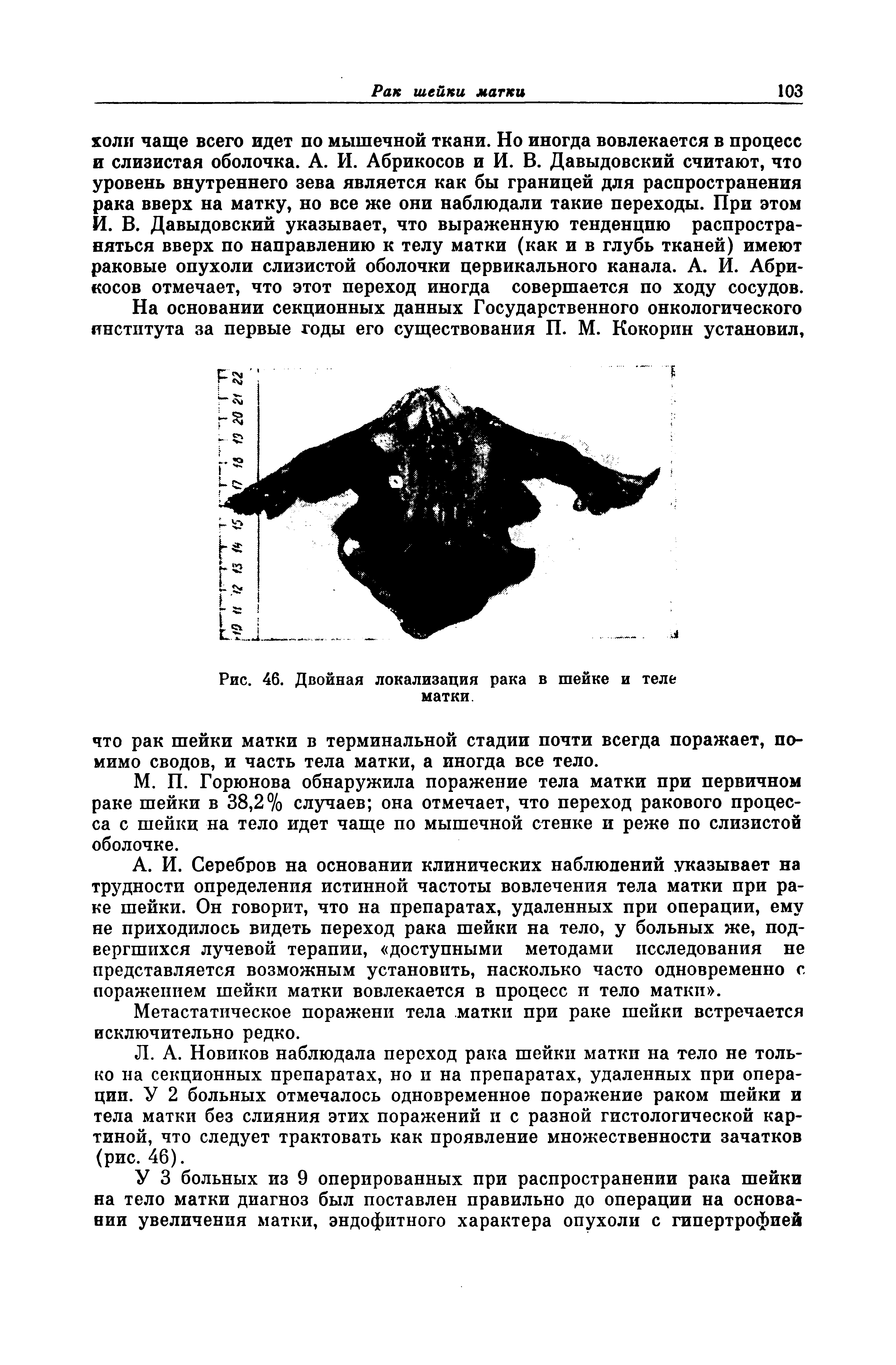 Рис. 46. Двойная локализация рака в шейке и теле матки.