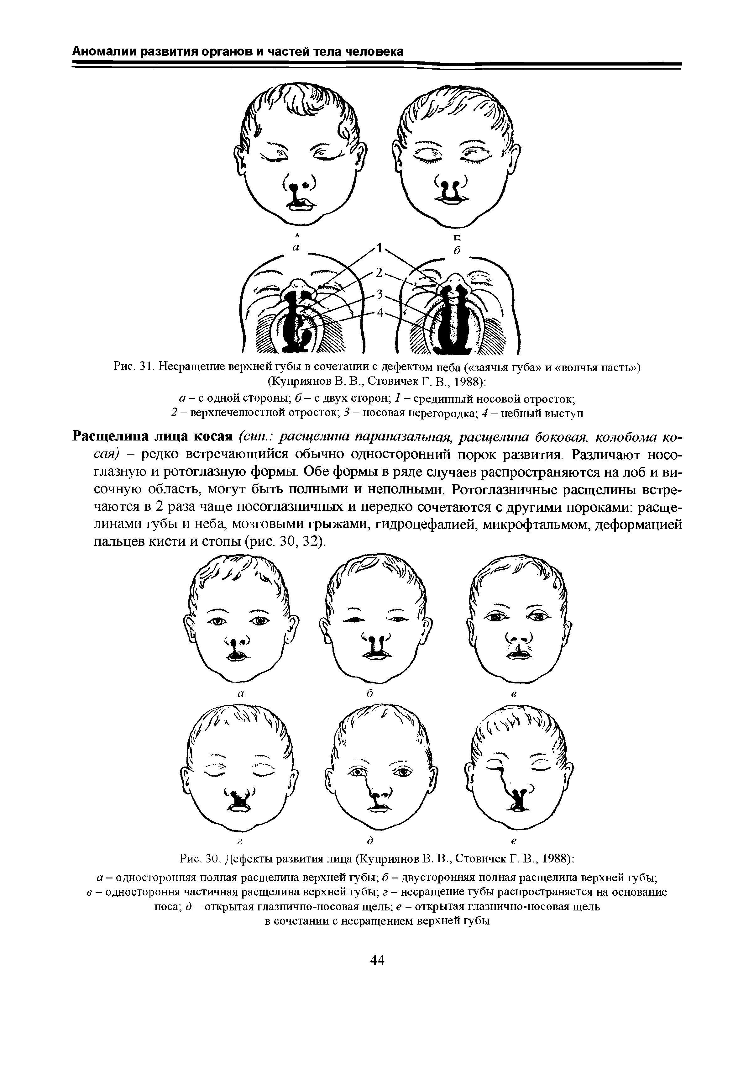 Рис. 31. Несращение верхней губы в сочетании с дефектом неба ( заячья губа и волчья пасть ) (Куприянов В. В., Стовичек Г. В., 1988) ...