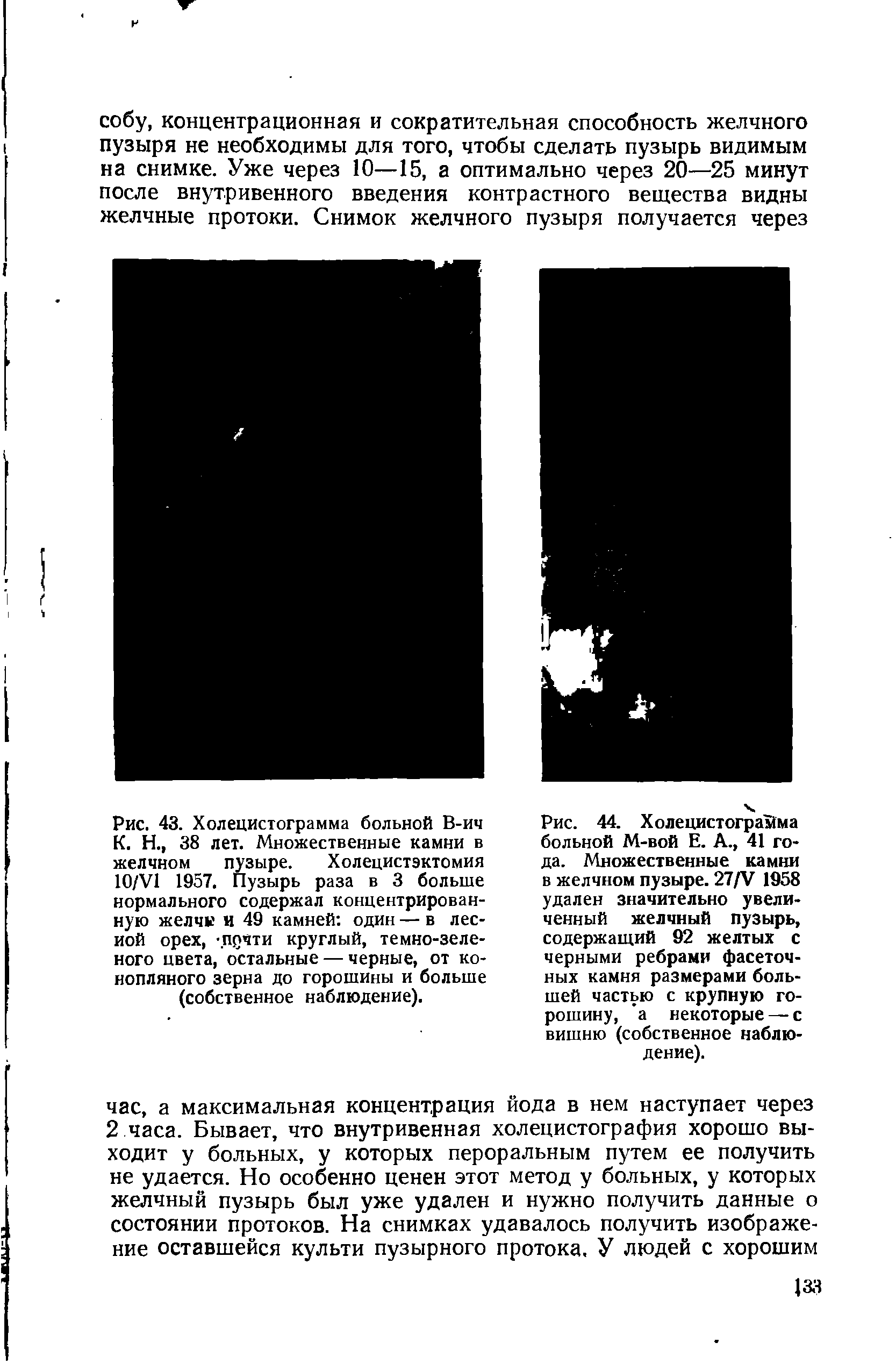 Рис. 43. Холецистограмма больной В-ич К. Н., 38 лет. Множественные камни в желчном пузыре. Холецистэктомия 10/V1 1957. Пузырь раза в 3 больше нормального содержал концентрированную желчи и 49 камней один — в лесной орех, -почти круглый, темно-зеленого цвета, остальные — черные, от конопляного зерна до горошины и больше (собственное наблюдение).