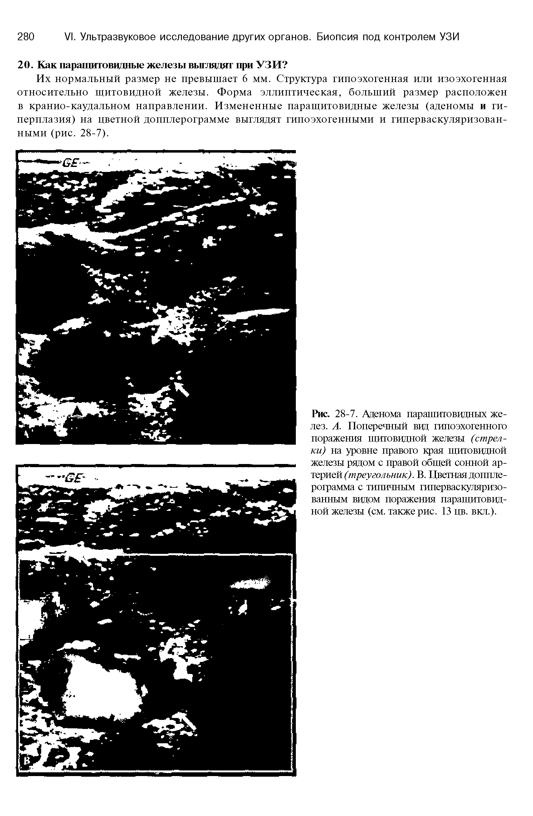 Рис. 28-7. Аденома паращитовидных желез. А. Поперечный вцд гипоэхогенного поражения щитовидной железы (стрелки) на уровне правого края щитовидной железы рядом с правой общей сонной артерией (треугольник). В. Цветная доппле-рограмма с типичным гиперваскуляризованным видом поражения паращитовидной железы (см. также рис. 13 цв. вкл.).