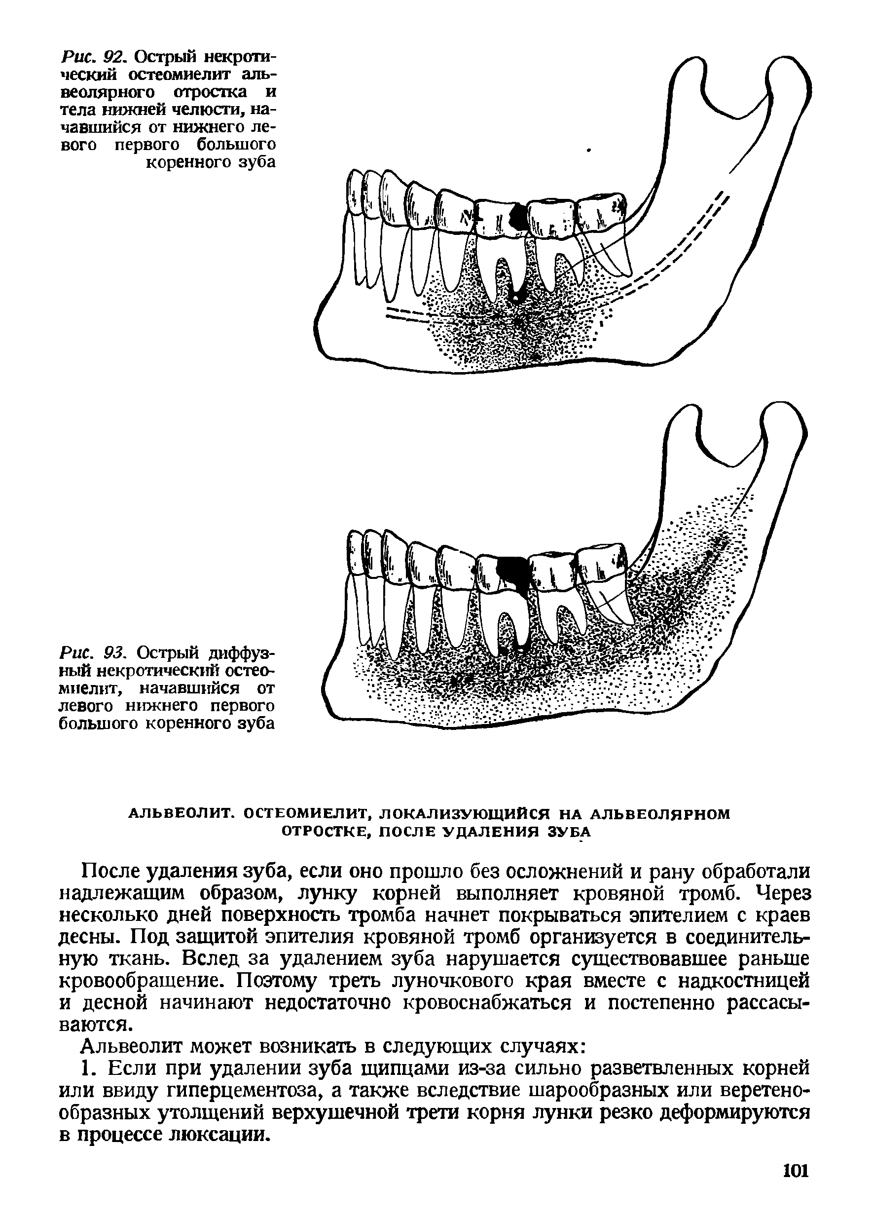 Рис. 93. Острый диффузный некротический остеомиелит, начавшийся от левого нижнего первого большого коренного зуба...