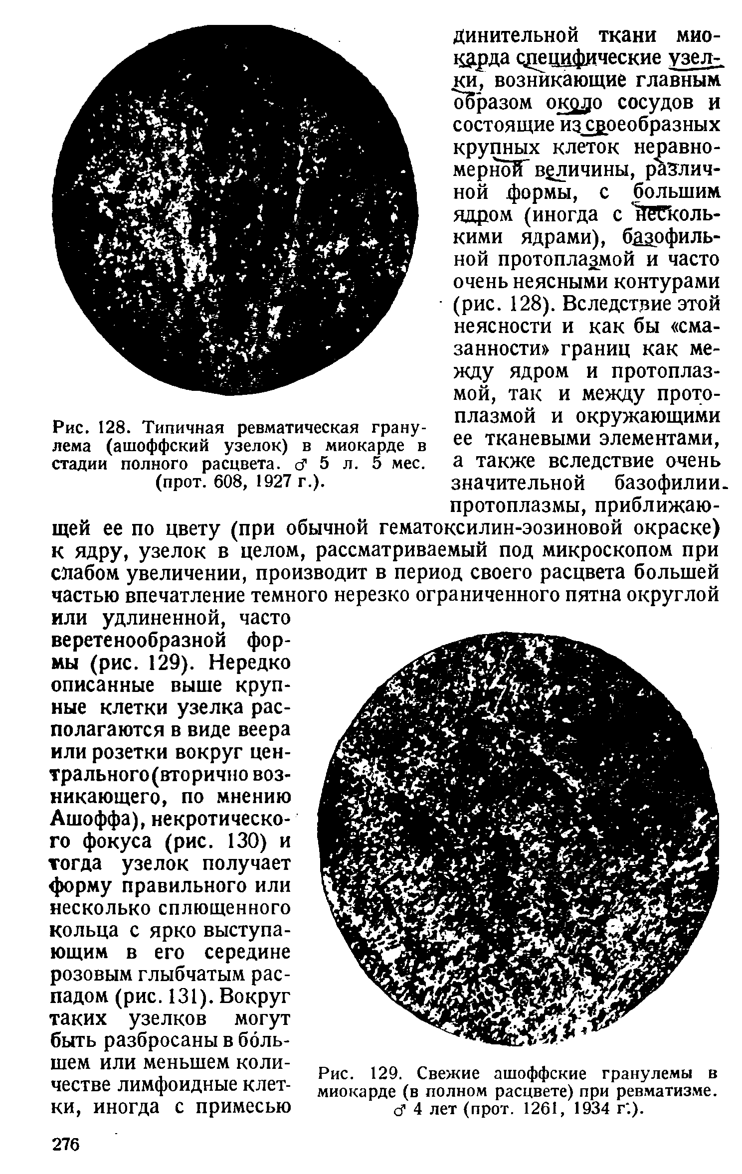 Рис. 128. Типичная ревматическая гранулема (ашоффский узелок) в миокарде в стадии полного расцвета. сГ 5 л. 5 мес. (прот. 608, 1927 г.).