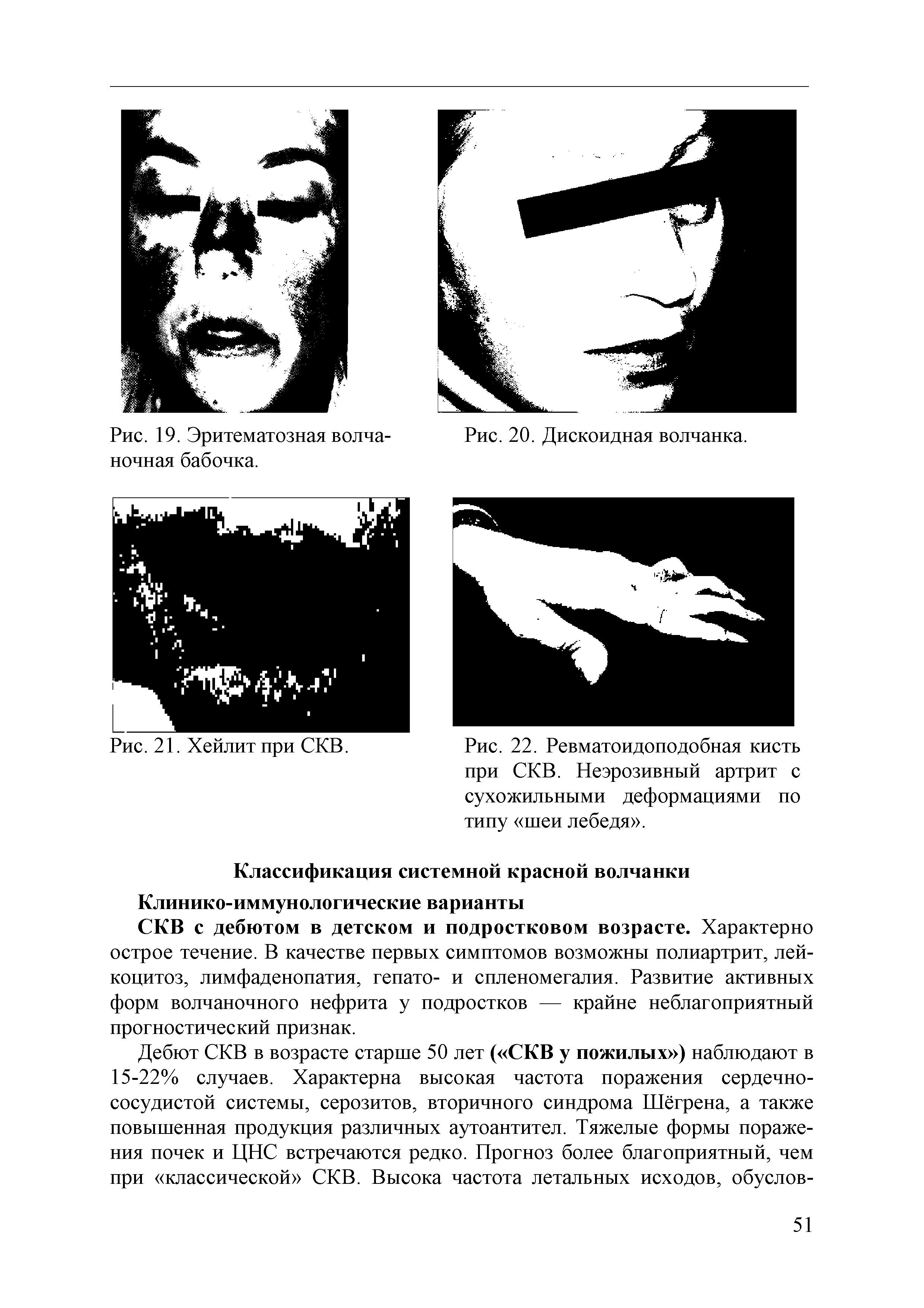 Рис. 22. Ревматоидоподобная кисть при СКВ. Неэрозивный артрит с сухожильными деформациями по типу шеи лебедя .