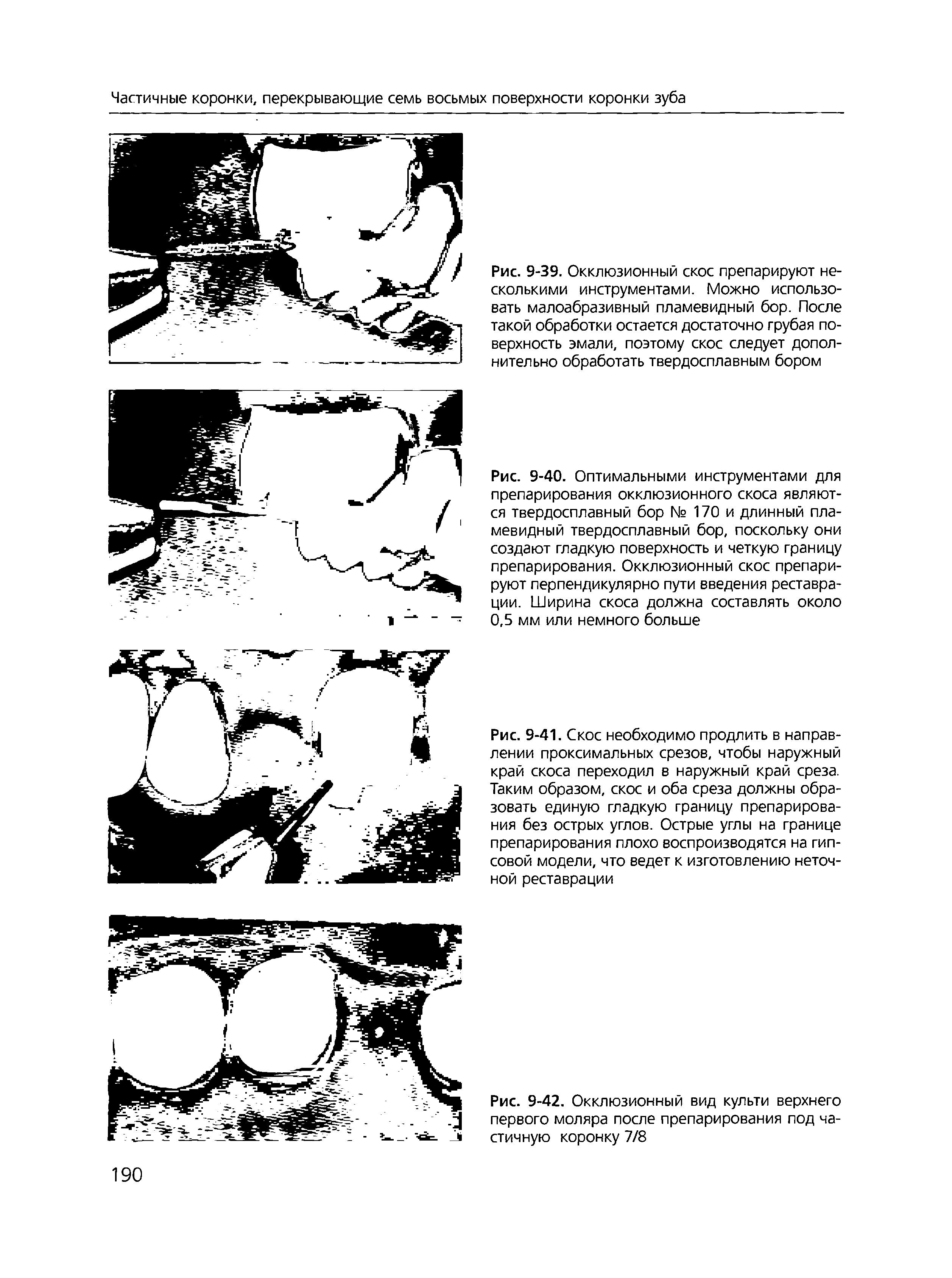 Рис. 9-40. Оптимальными инструментами для препарирования окклюзионного скоса являются твердосплавный бор № 170 и длинный пламевидный твердосплавный бор, поскольку они создают гладкую поверхность и четкую границу препарирования. Окклюзионный скос препарируют перпендикулярно пути введения реставрации. Ширина скоса должна составлять около 0,5 мм или немного больше...
